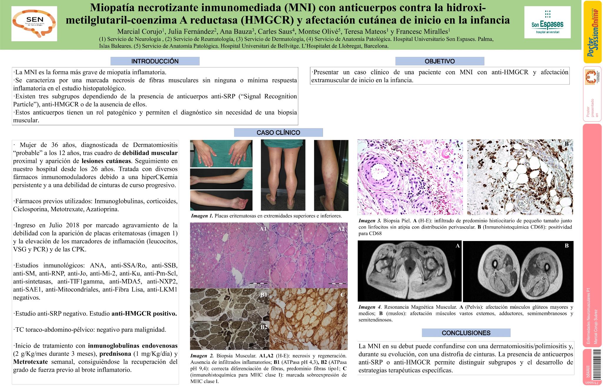 Miopatía Necrotizante Inmunomediada (MNI) con anticuerpos contra la Hidroxi-Metilglutaril-Coenzima A Reductasa (HMGCR) y afectación cutánea de inicio en la infancia