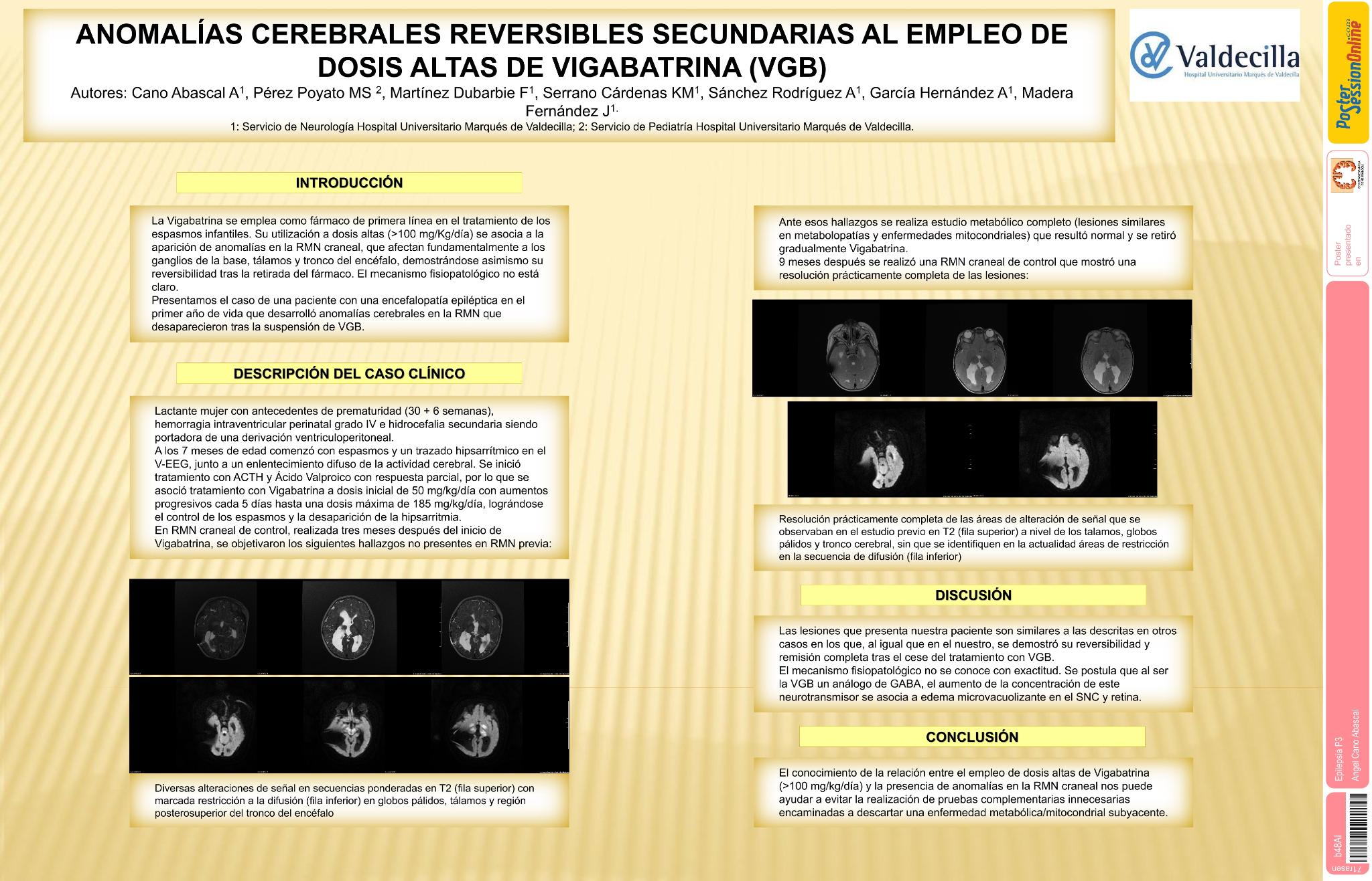 Anomalías cerebrales reversibles secundarias al empleo de dosis altas de Vigabatrina