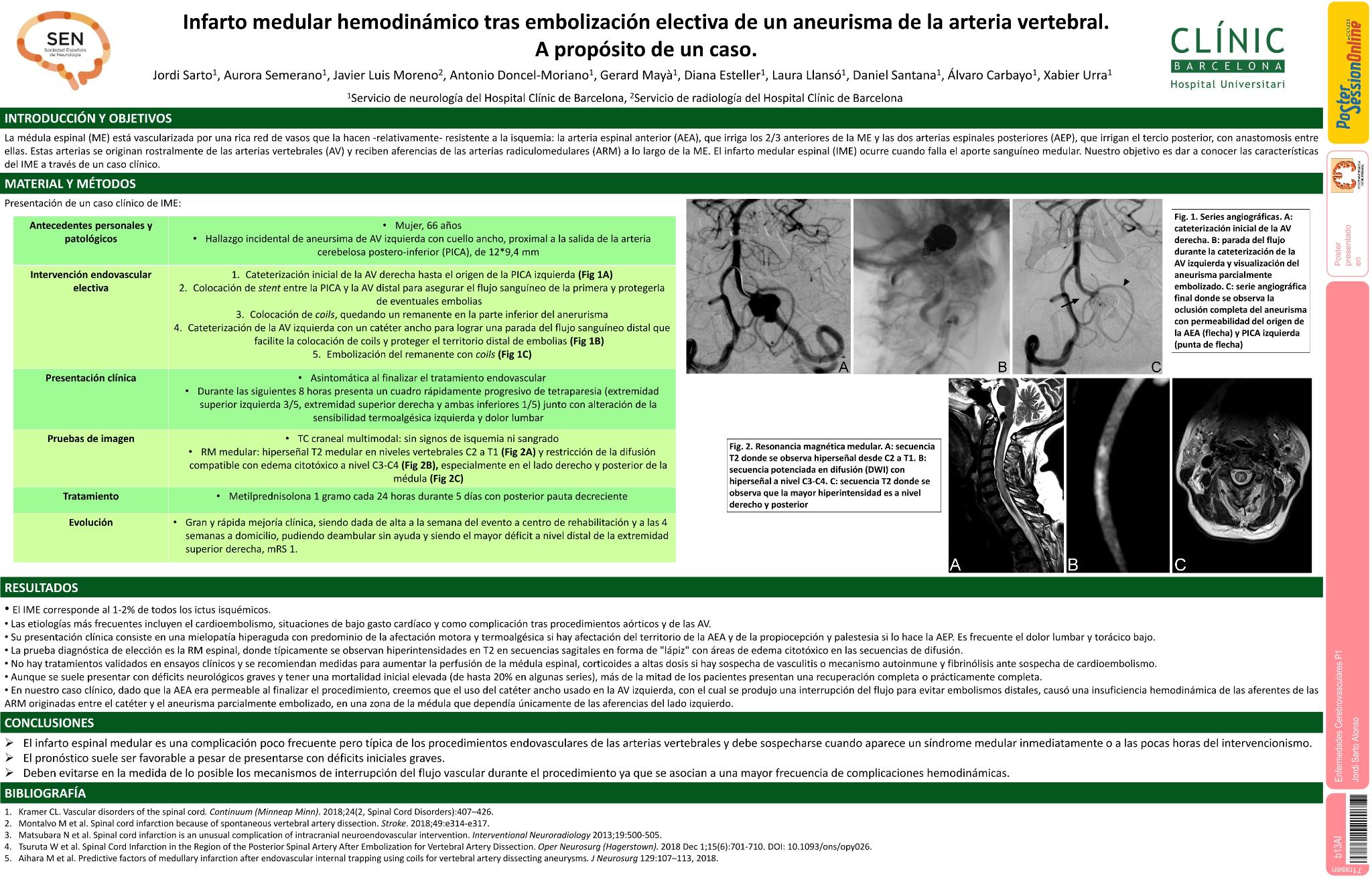 Infarto medular hemodinámico tras embolización electiva de un aneurisma de la arteria vertebral. A propósito de un caso