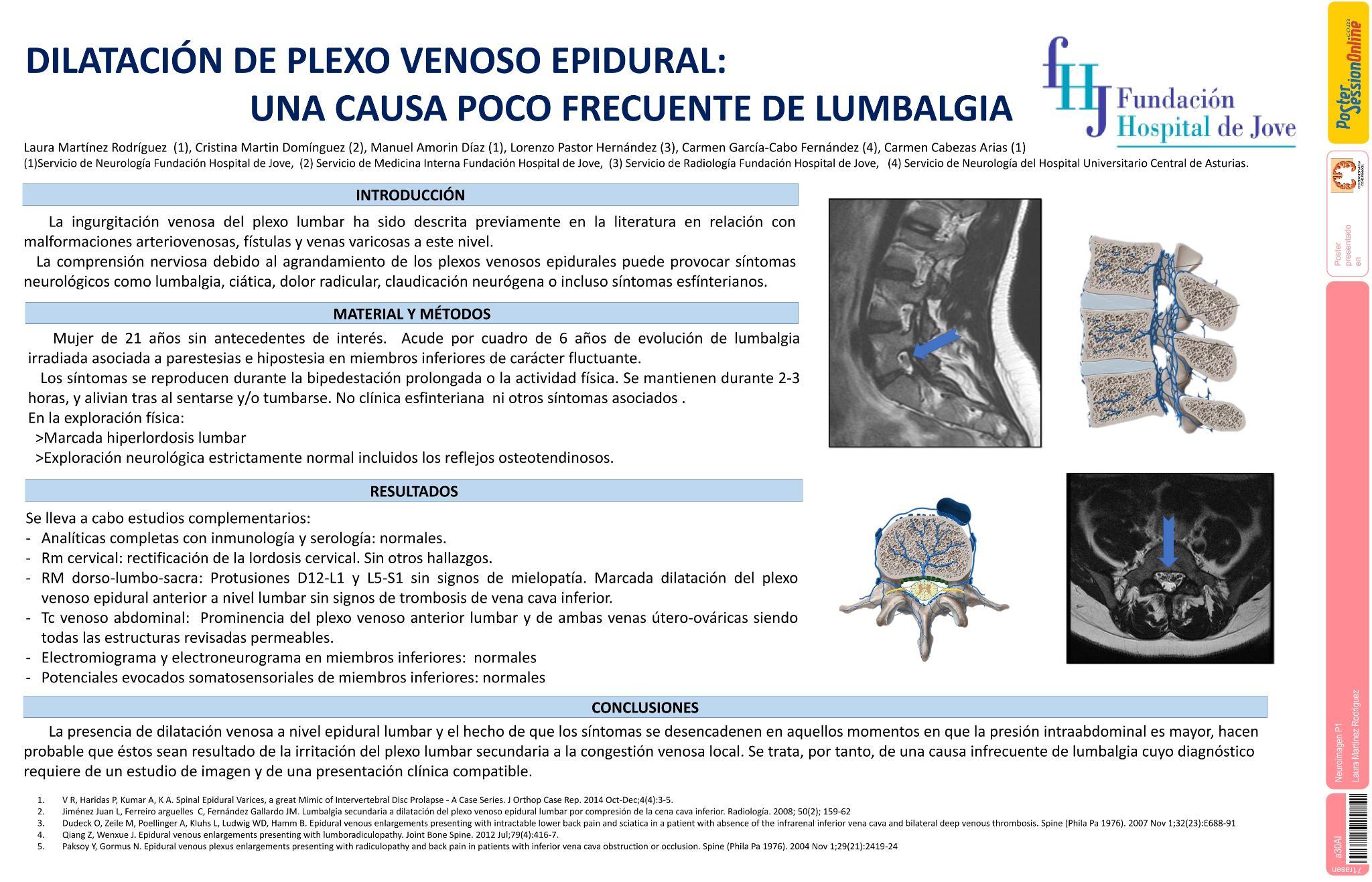 Dilatación de plexo venoso epidural: una causa poco frecuente de lumbalgia