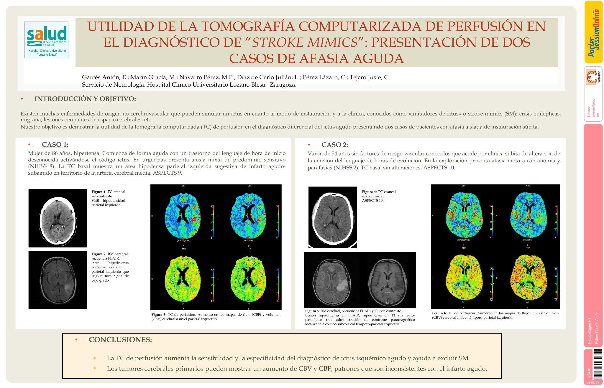 Utilidad de la tomografía computarizada de perfusión en el diagnóstico de “stroke mimics”: presentación de dos casos de afasia aguda