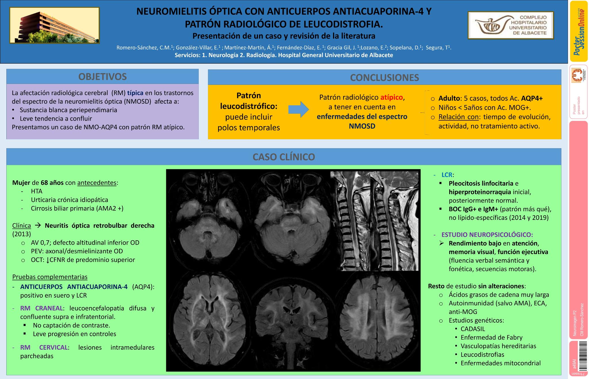 Neuromielitis óptica con patrón leucodistrófico en RM cerebral. Presentación de un caso y revisión de la literatura