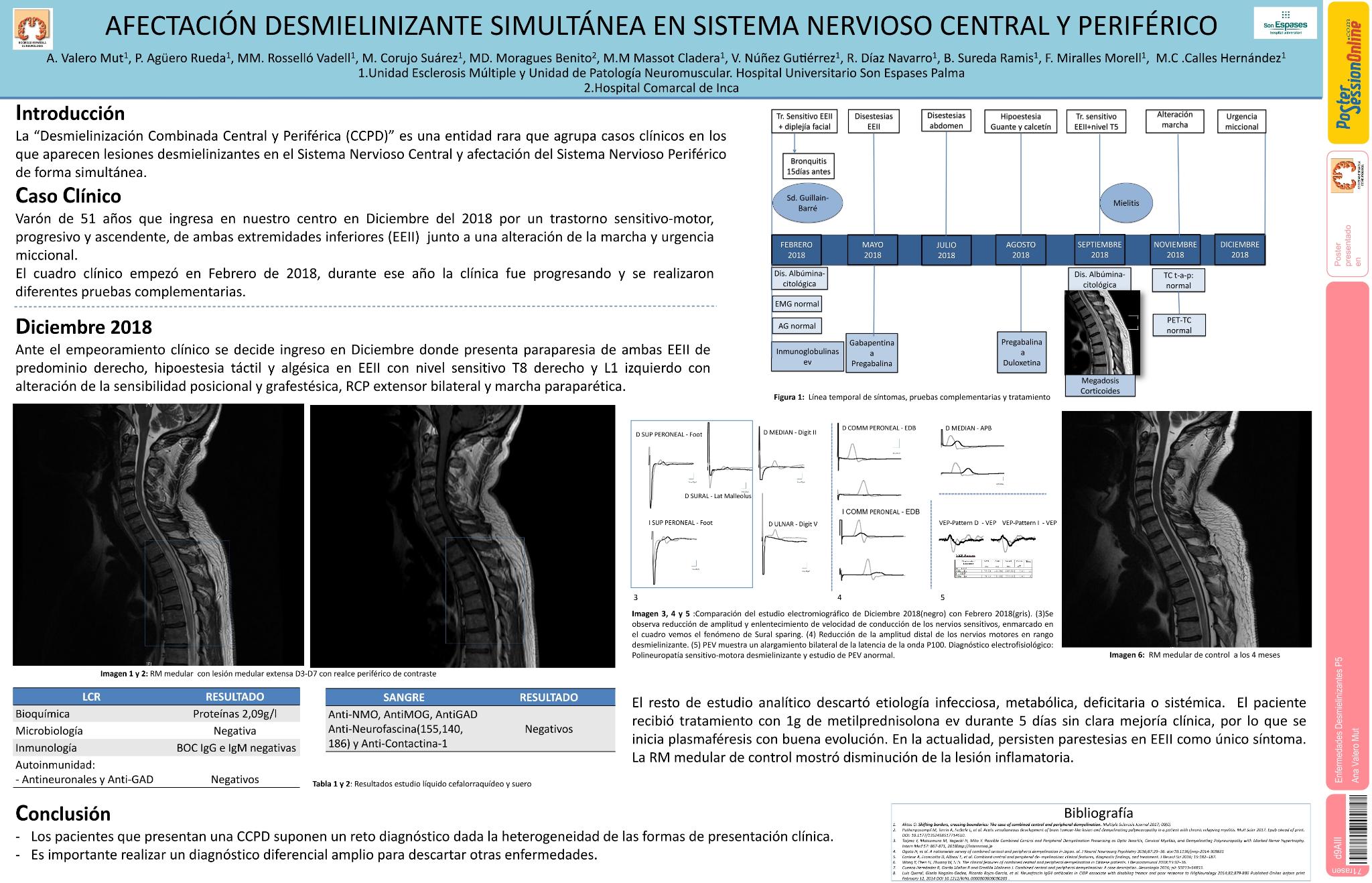 Afectación desmielinizante simultánea en Sistema Nervioso Central y Periférico