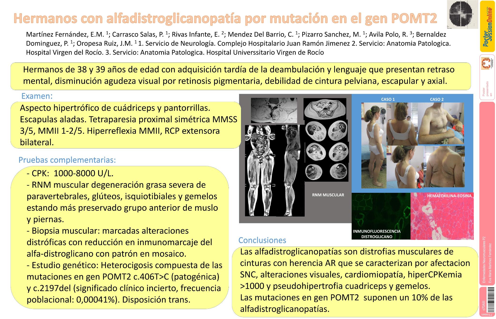 Hermanos con alfadistroglicanopatía por mutación en el gen POMT2
