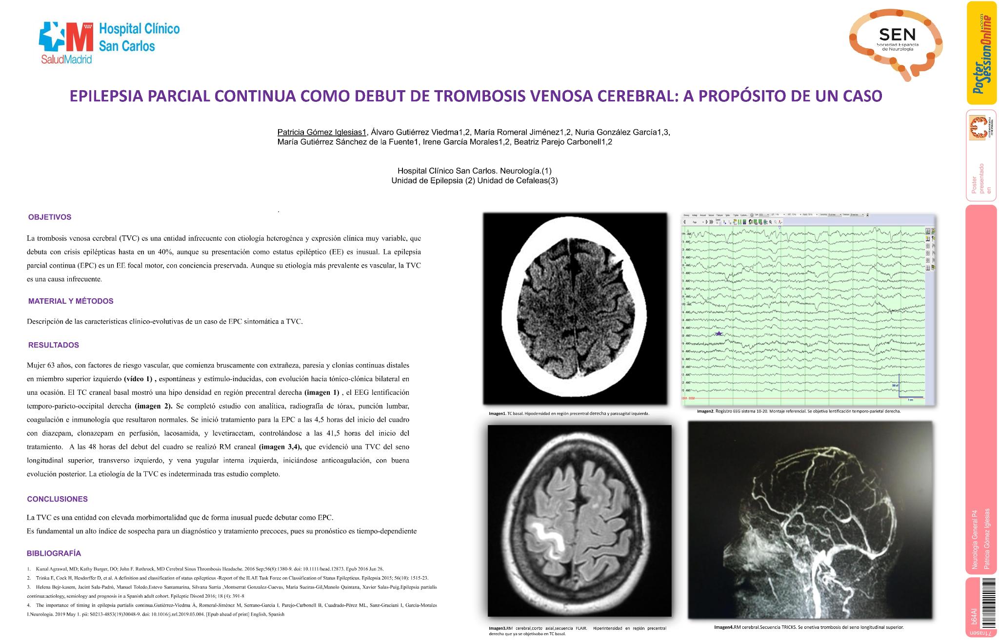 Epilepsia parcial continua como debut de trombosis venosa cerebral: a propósito de un caso