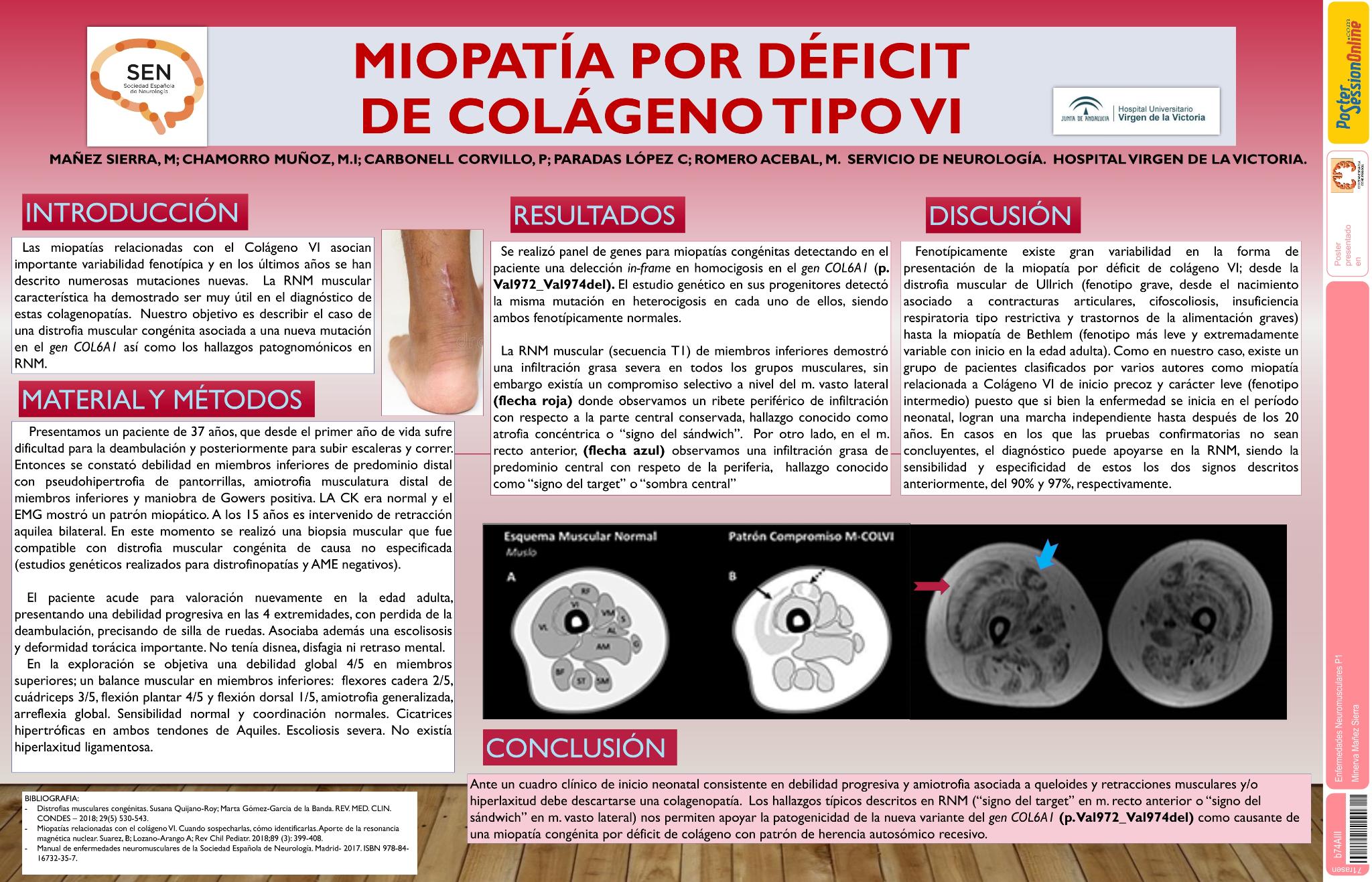 Miopatia por déficit de colágeno VI
