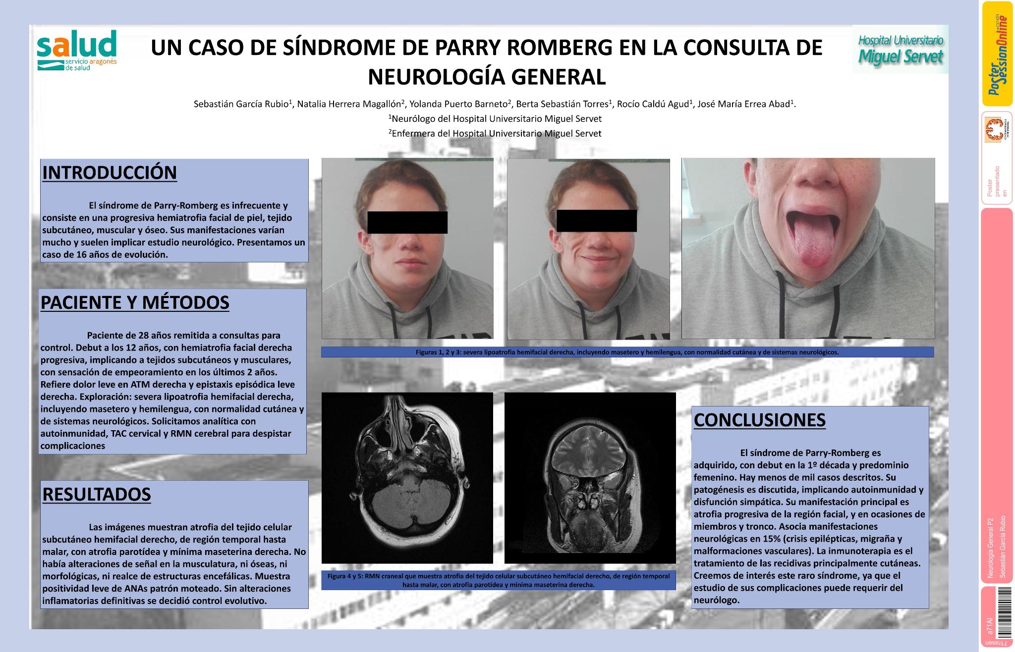 Un caso de síndrome de Parry Romberg en la consulta de neurología general