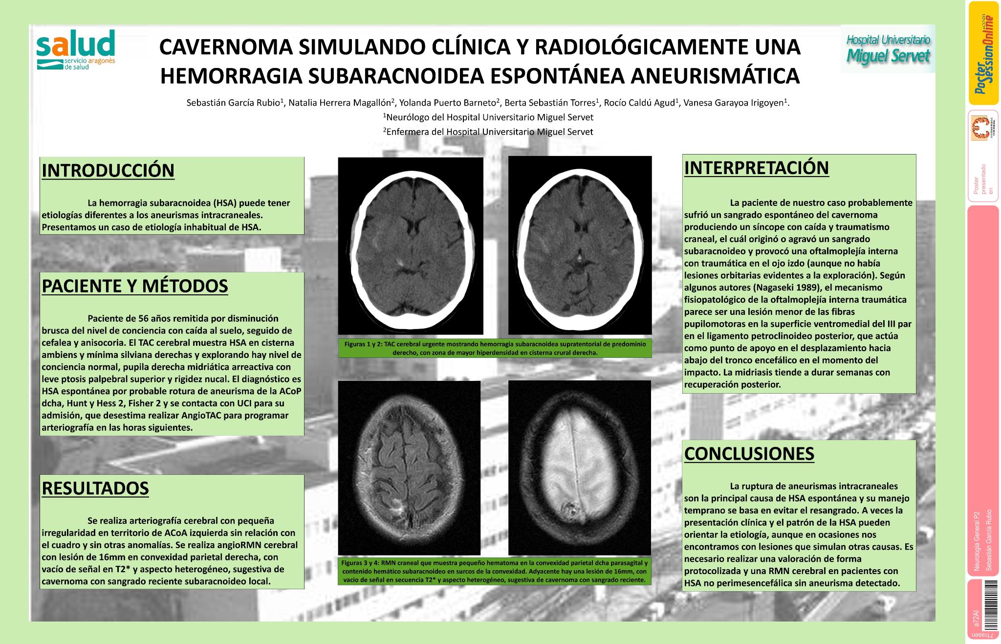 Cavernoma simulando clínica y radiológicamente una hemorragia subaracnoidea espontánea aneurismática