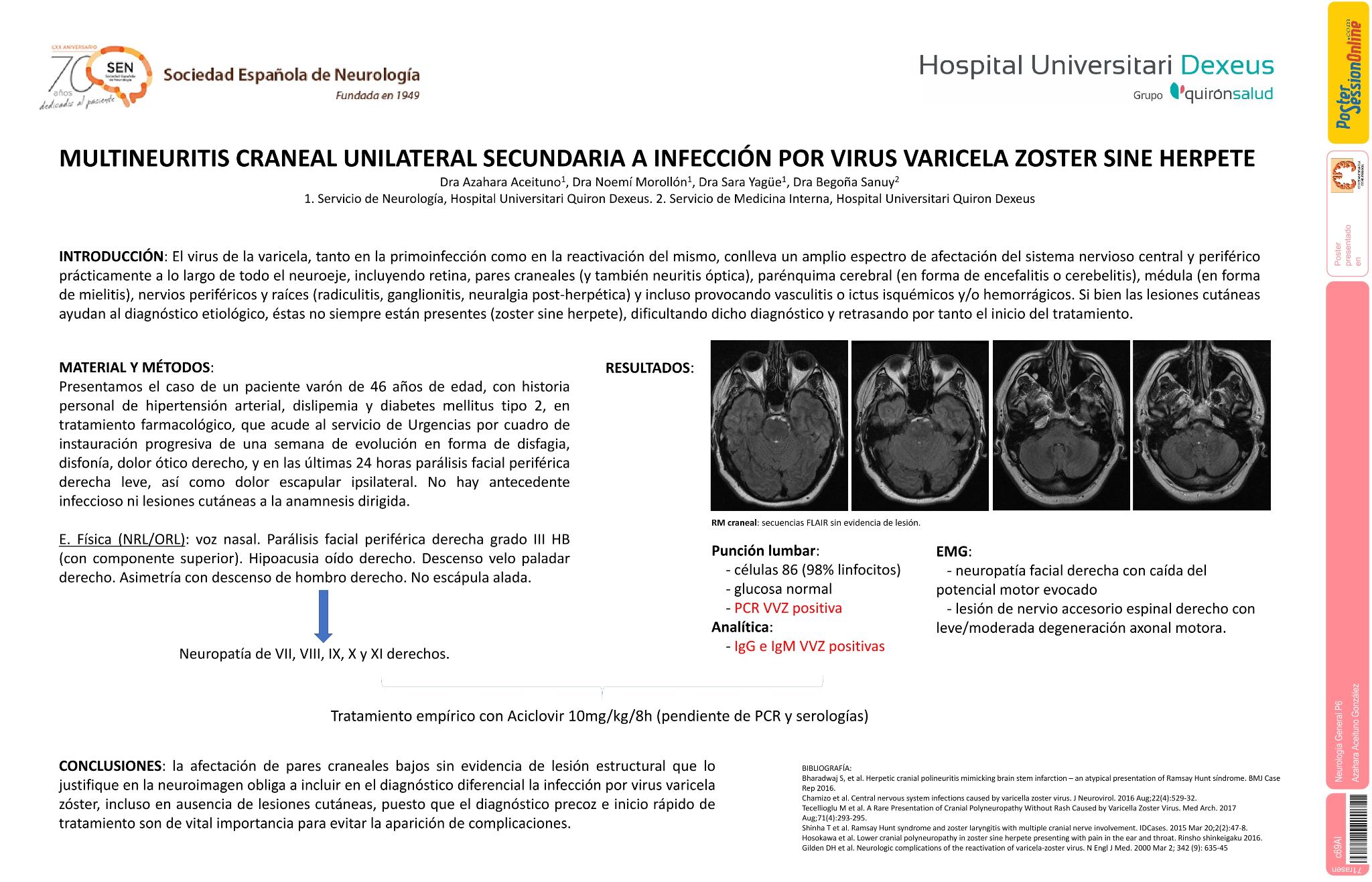 Multineuritis craneal unilateral secundaria a infección por virus varicela zóster sine herpete