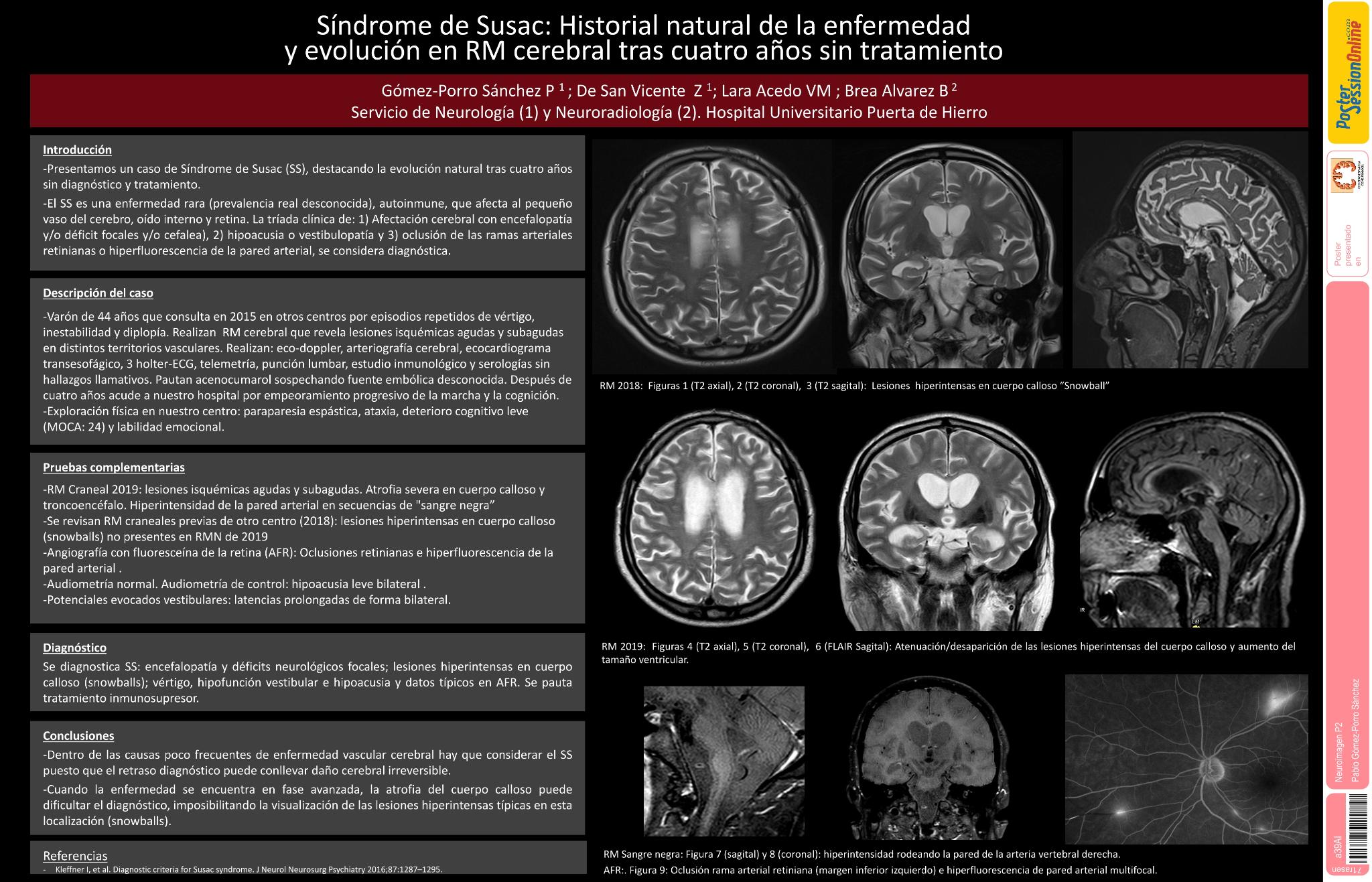 Síndrome de Susac: Historial natural de la enfermedad y evolución en resonancia magnética cerebral después de cuatro años sin tratamiento