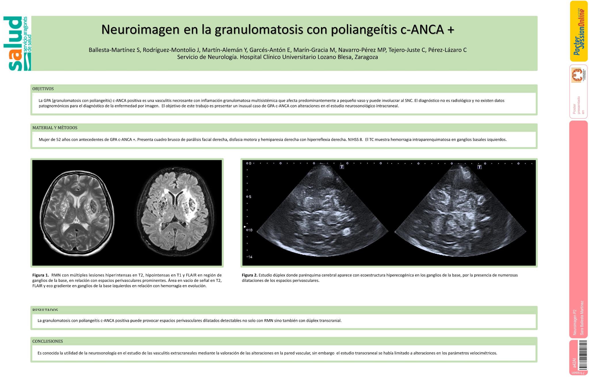 Neuroimagen en la granulomatosis con poliangeítis c-ANCA +. A propósito de un caso