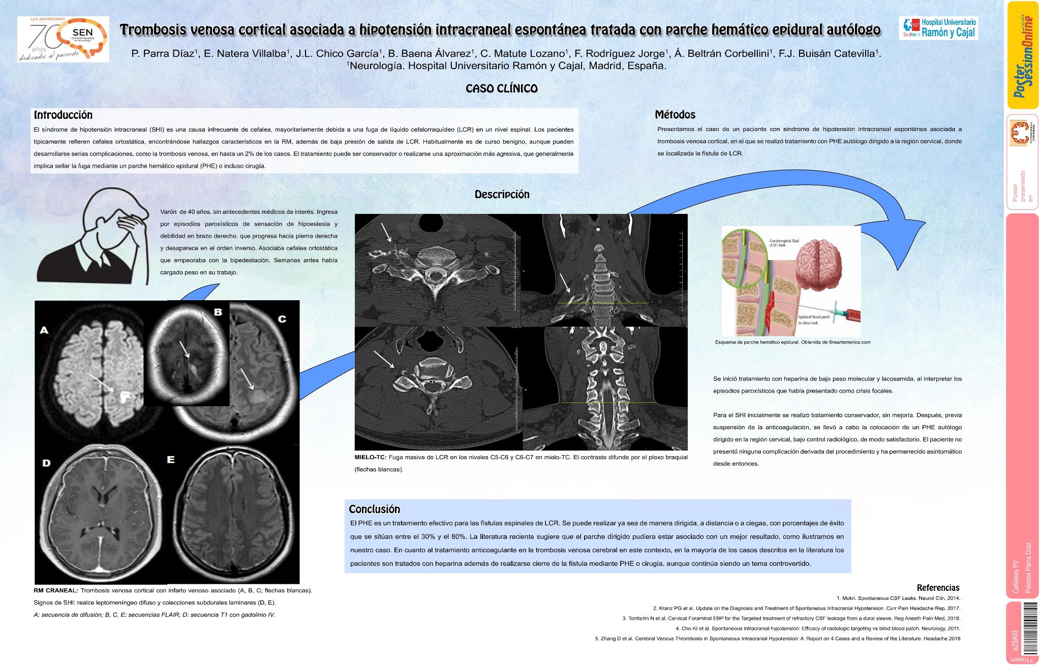 Trombosis venosa cortical asociada a hipotensión intracraneal espontánea tratada con parche hemático epidural autólogo