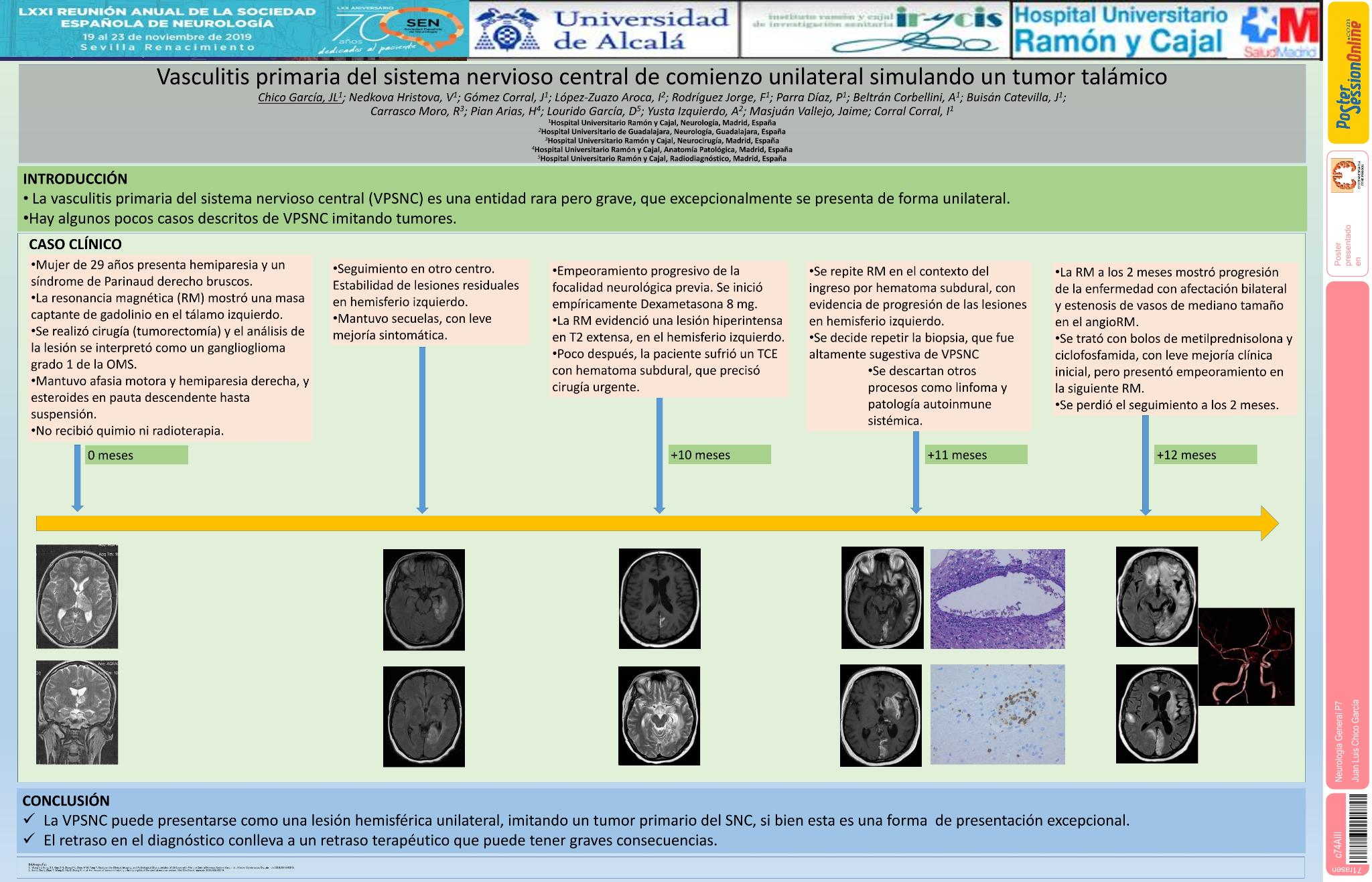 Vasculitis primaria del sistema nervioso central de comienzo unilateral simulando un tumor talámico