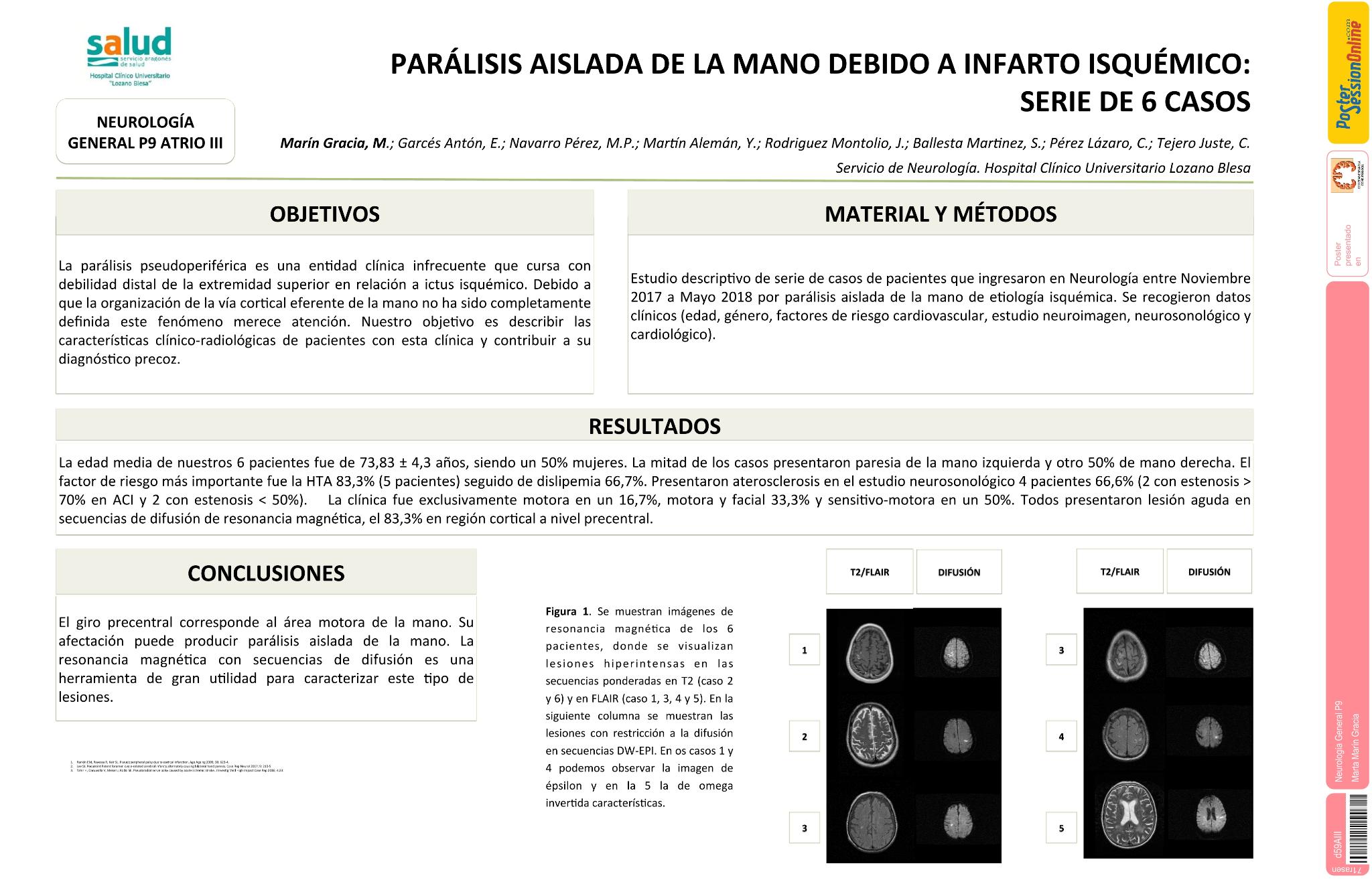 Parálisis aislada de la mano debido a infarto isquémico: Serie de 6 casos