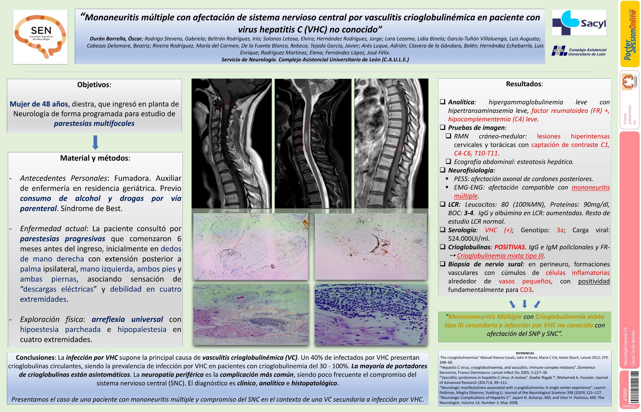 Mononeuritis múltiple con afectación de sistema nervioso central por vasculitis crioglobulinémica en paciente con virus hepatitis C no conocido