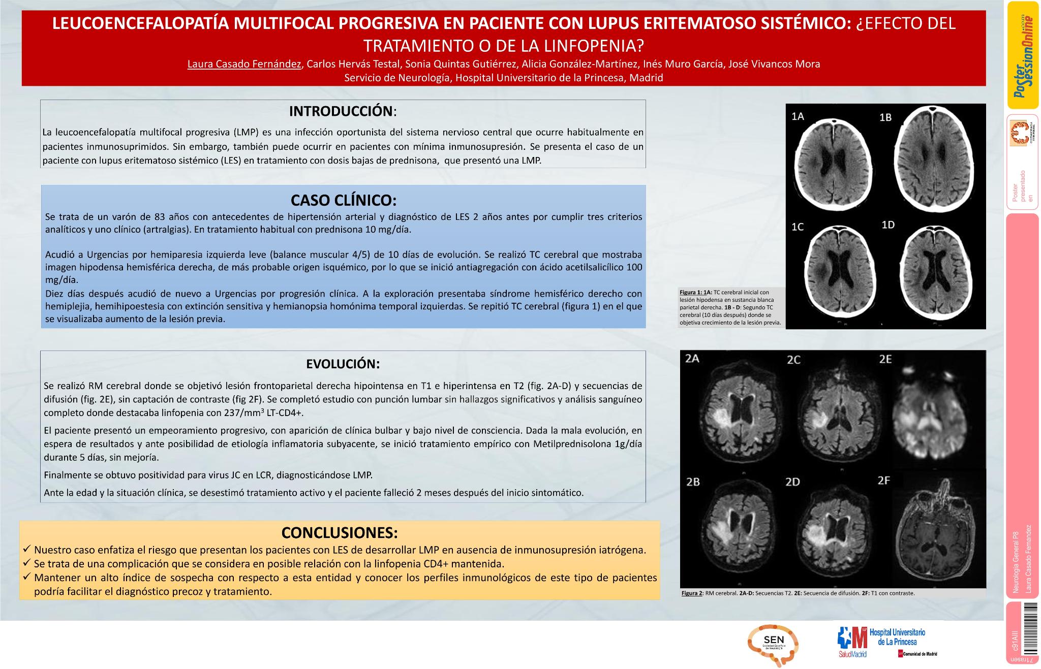 Leucoencefalopatía multifocal progresiva en paciente con lupus eritematoso sistémico: ¿efecto del tratamiento o de la linfopenia CD4?