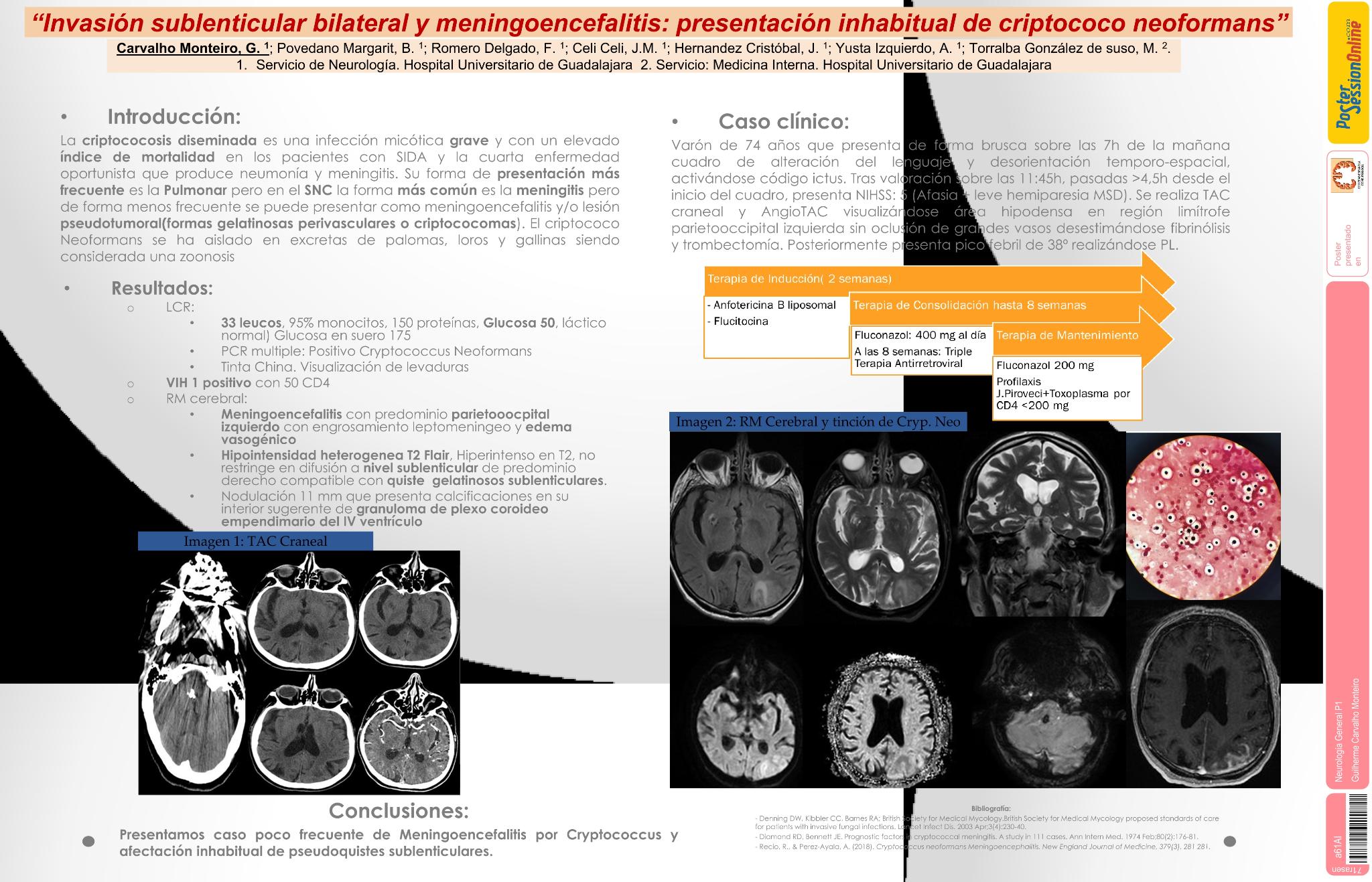 Invasión sublenticular bilateral y meningoencefalitis: presentación inhabitual de criptococo neoformans