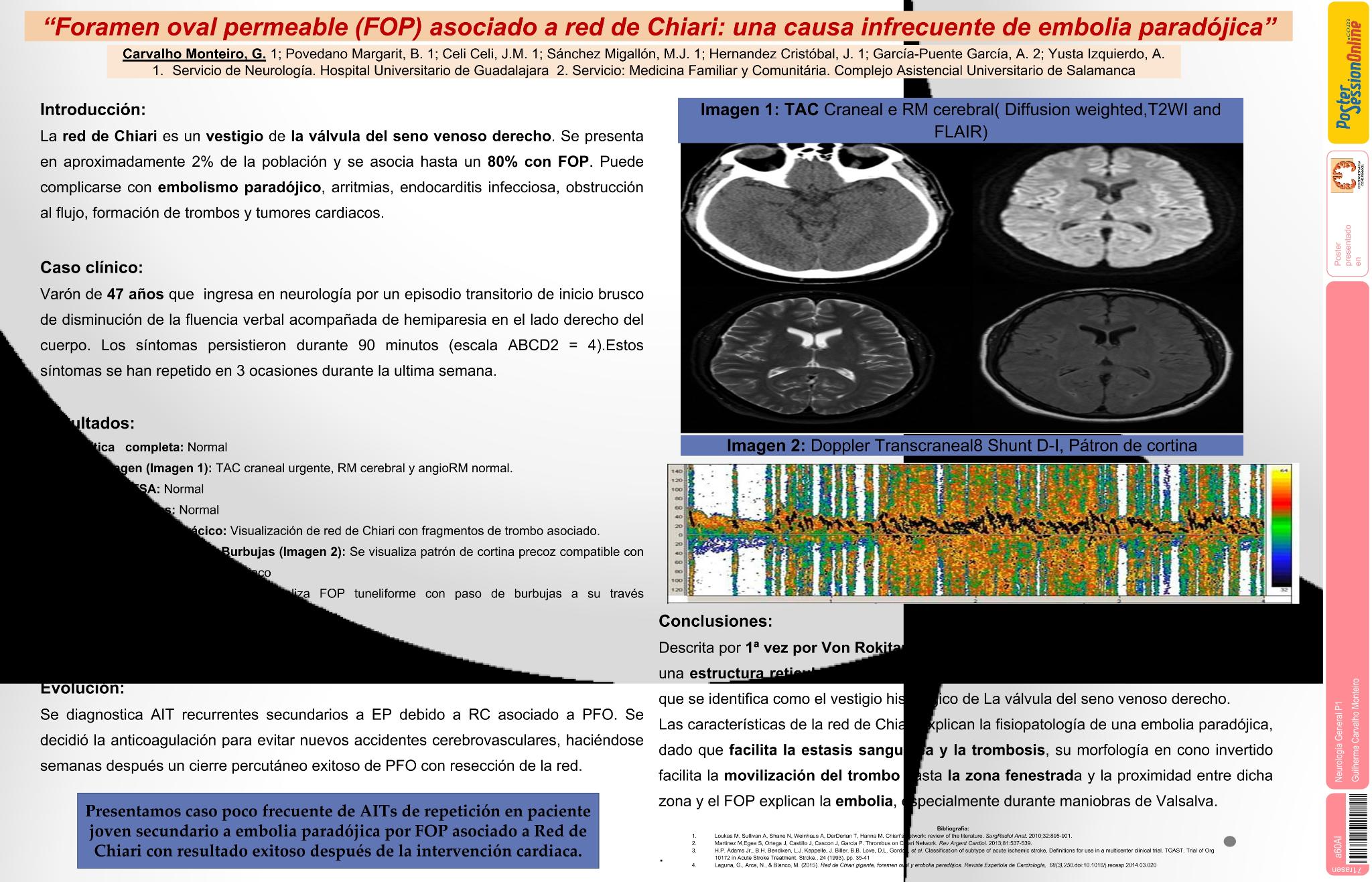 Foramen oval permeable (FOP) asociado a red de Chiari: una causa infrecuente de embolia paradójica