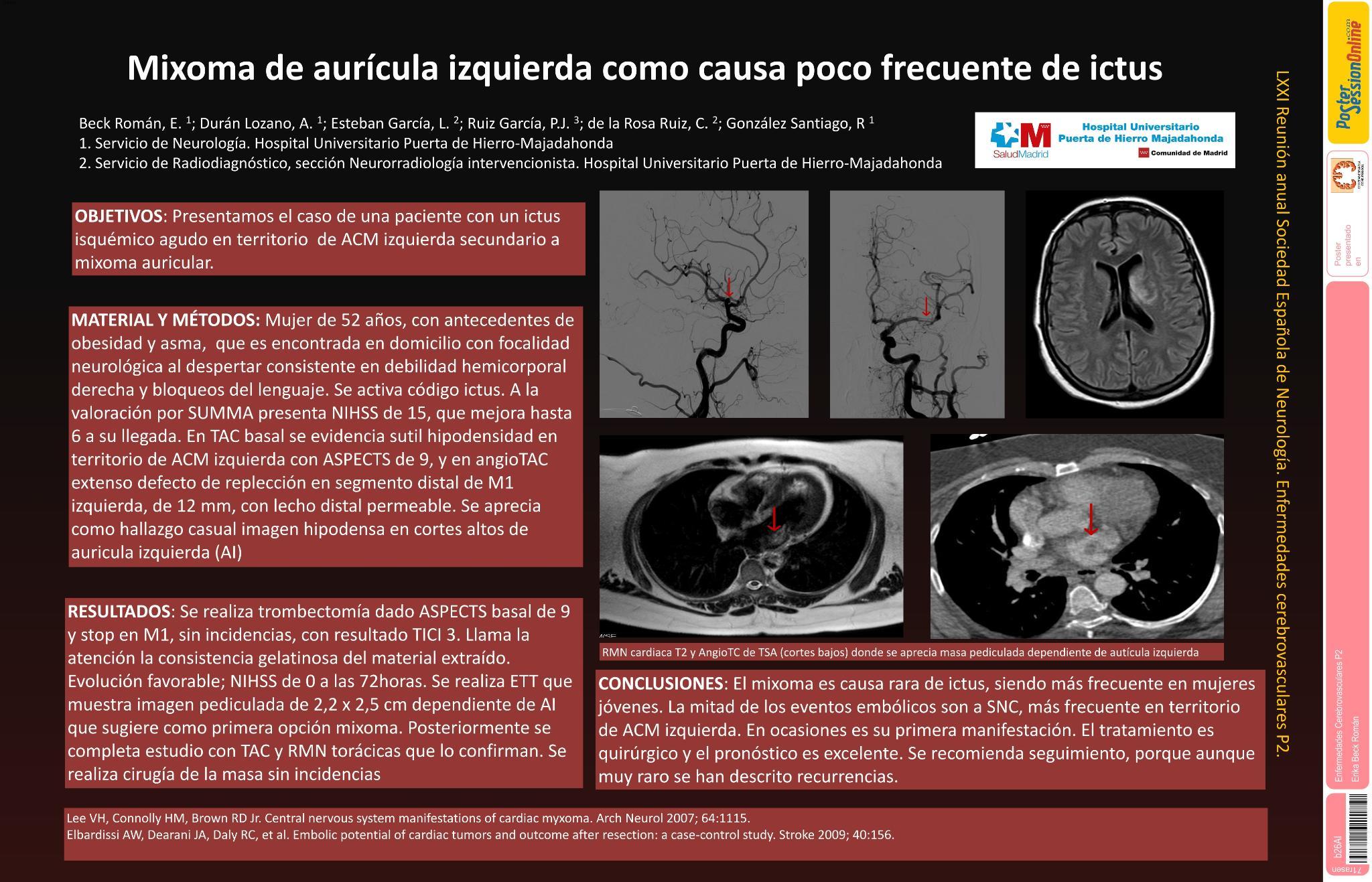 Mixoma de aurícula izquierda como causa poco frecuente de ictus