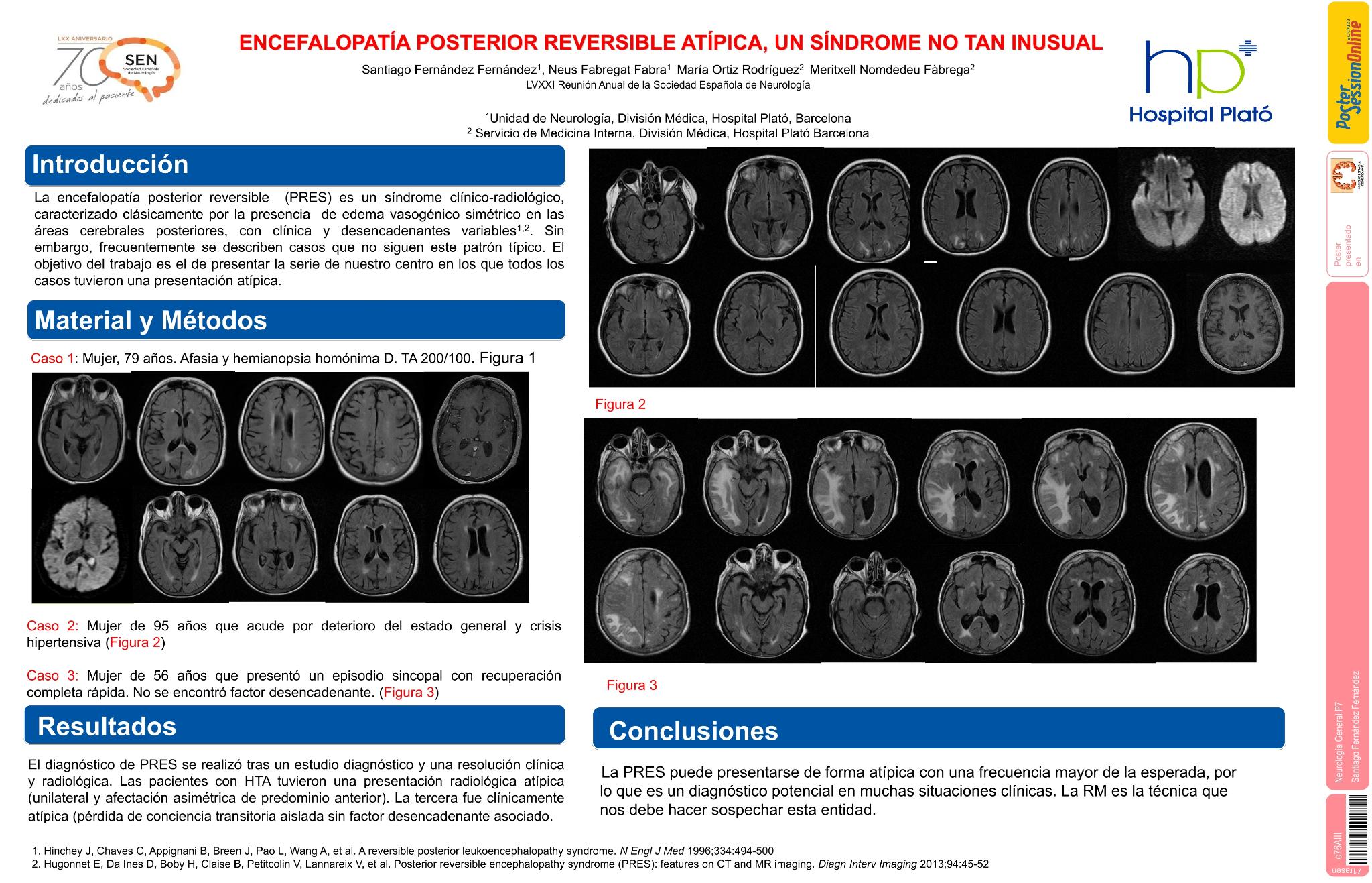 Encefalopatía posterior reversible atípica: un síndrome no tan inusual