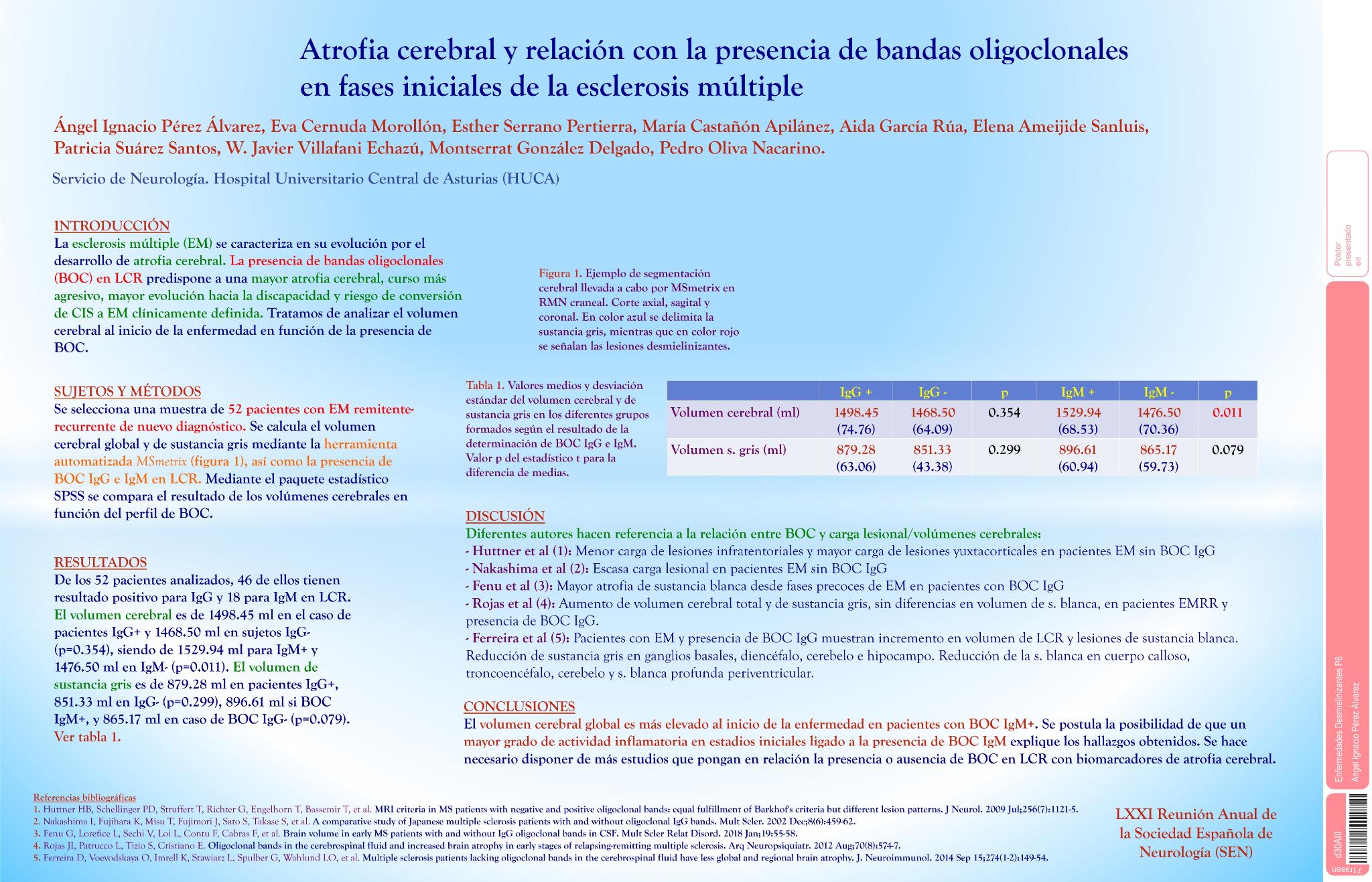 Atrofia cerebral y relación con la presencia de bandas oligoclonales en fases iniciales de la esclerosis múltiple