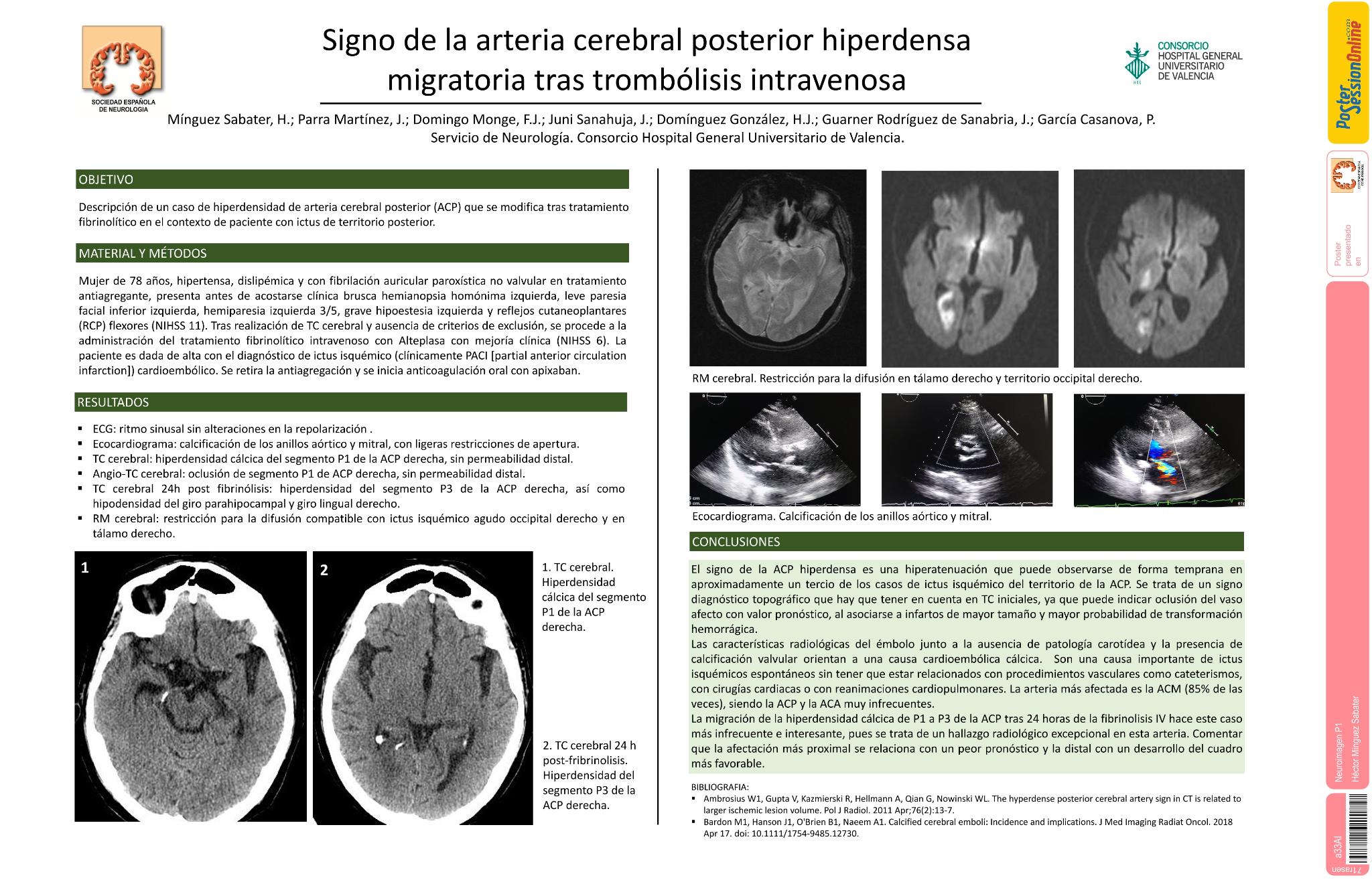 Signo de la arteria cerebral posterior hiperdensa migratoria tras trombólisis intravenosa