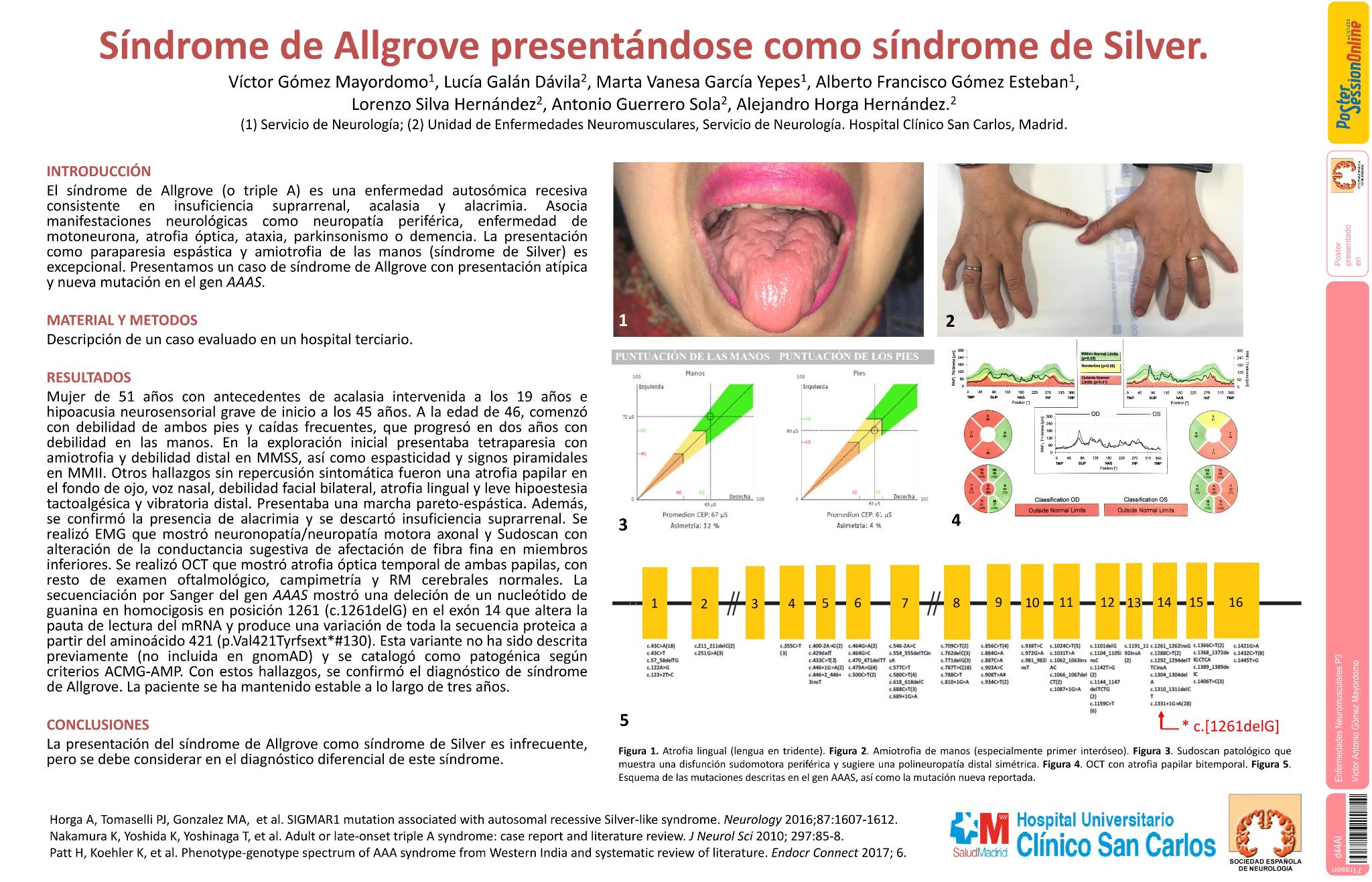 Síndrome de Allgrove presentándose como síndrome de Silver