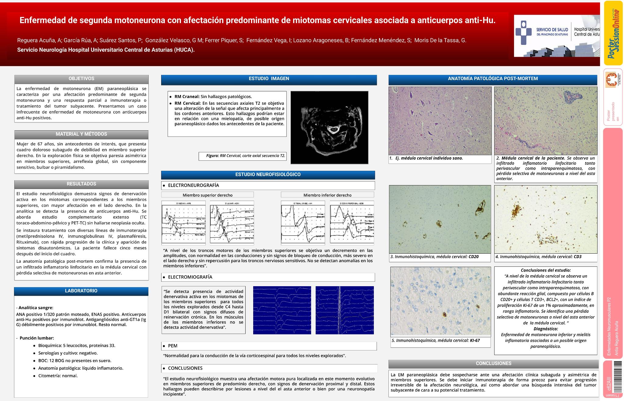 Enfermedad de segunda motoneurona con afectación predominante de miotomas cervicales asociada a anticuerpos  anti-Hu