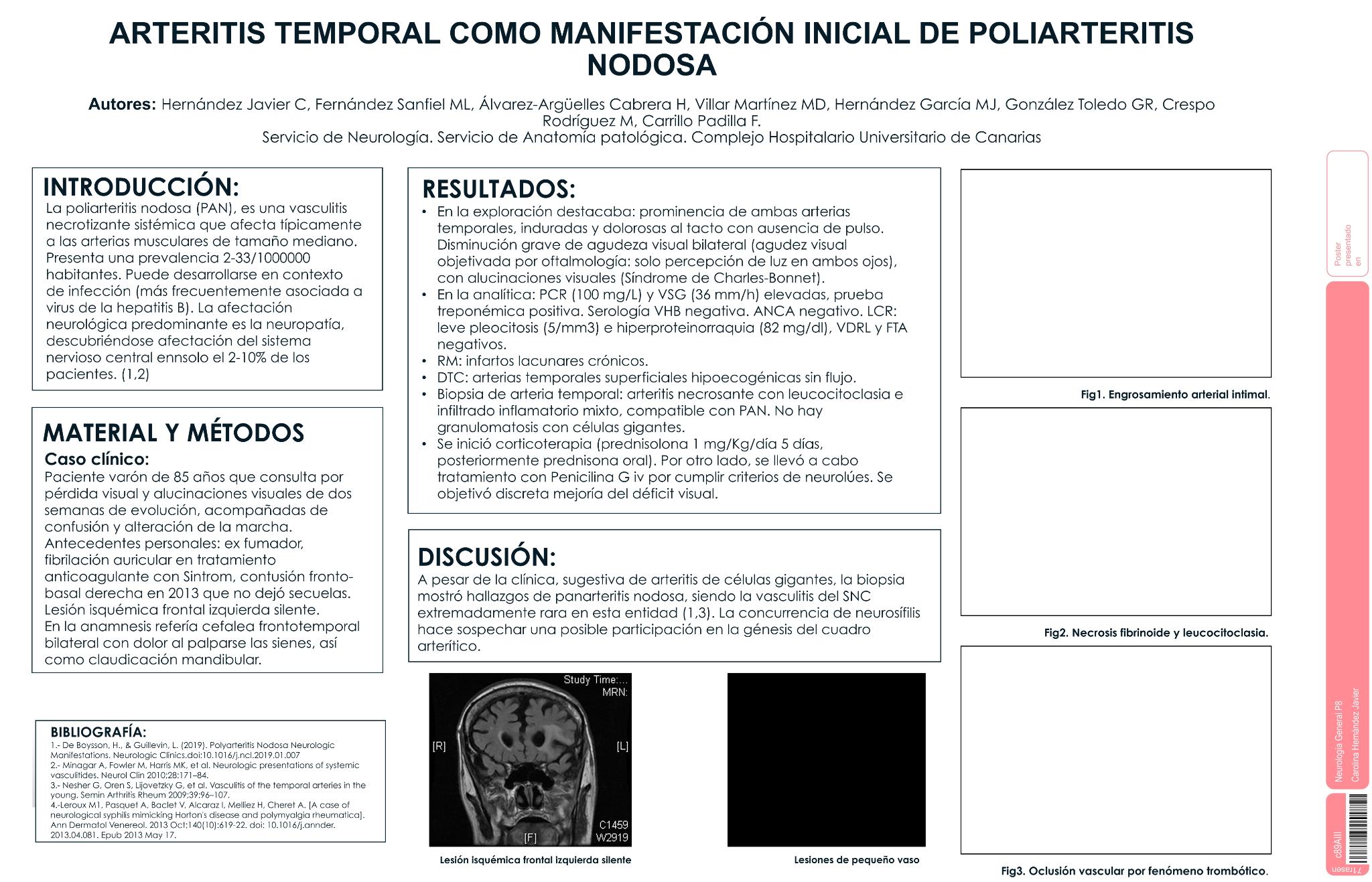 Arteritis temporal como manifestación inicial de poliarteritis nodosa