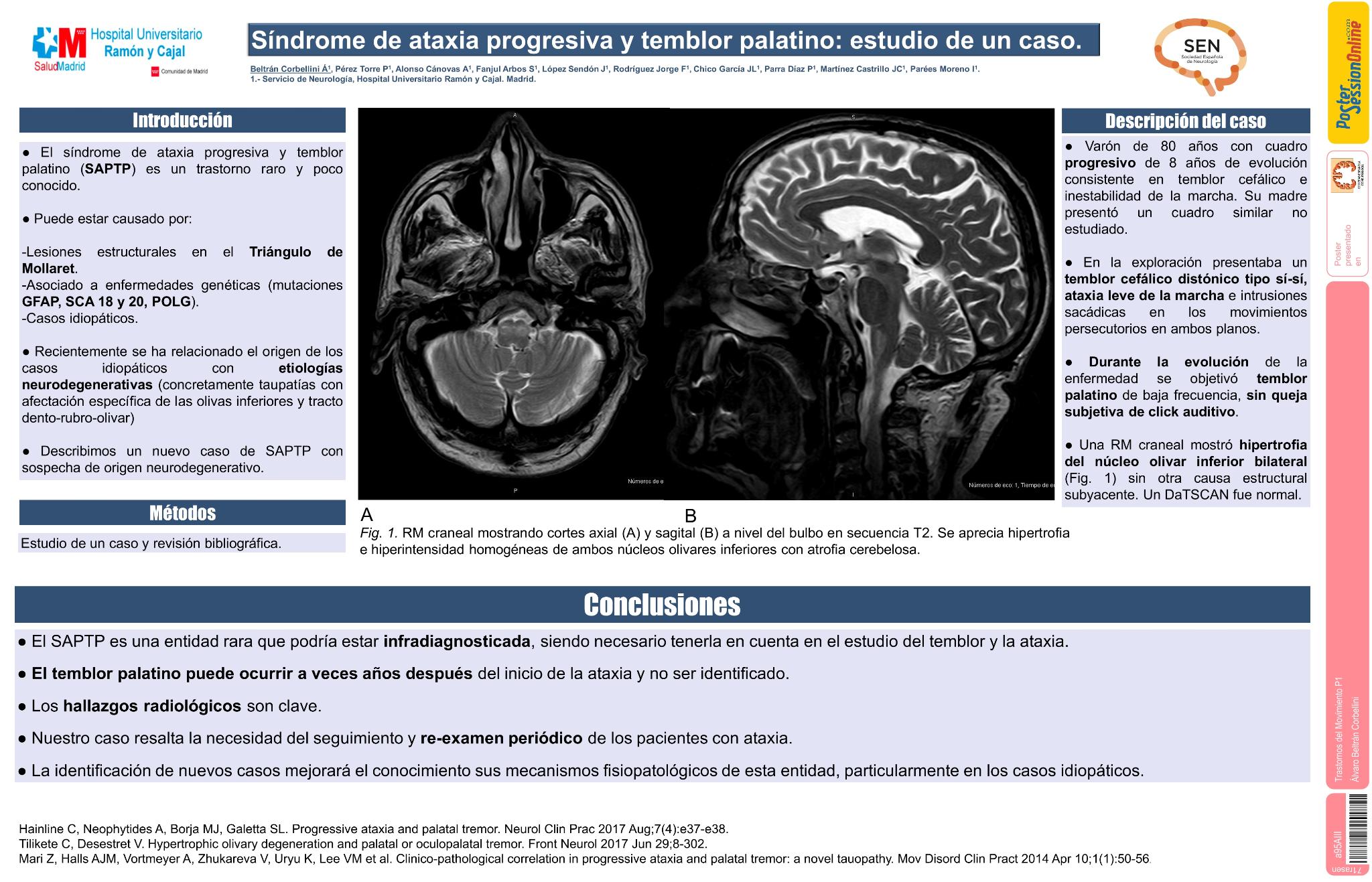 Síndrome de ataxia progresiva y temblor palatino: estudio de un caso y revisión de la literatura