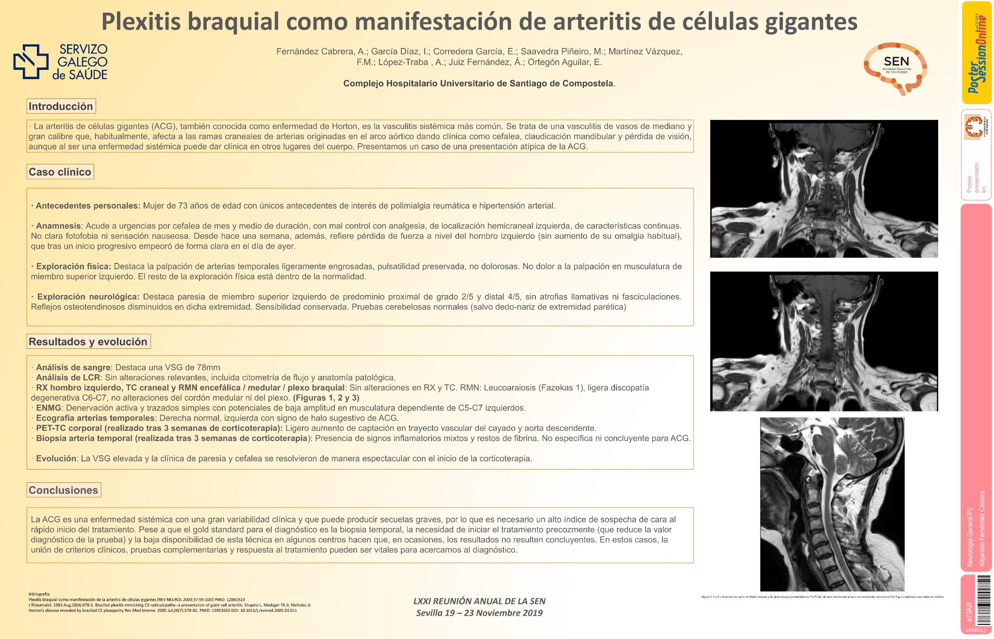 Plexitis braquial como manifestación de Arteritis de células gigantes