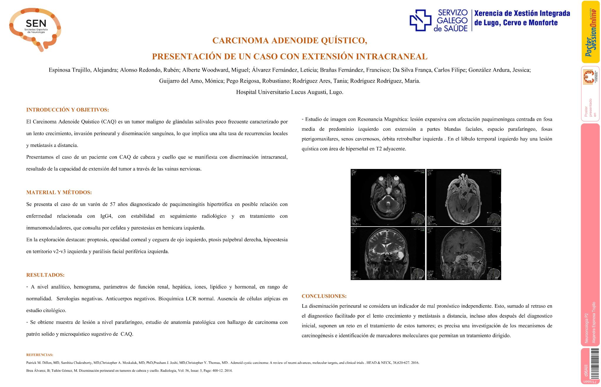 Carcinoma adenoide quístico, presentación de un caso con extensión intracraneal