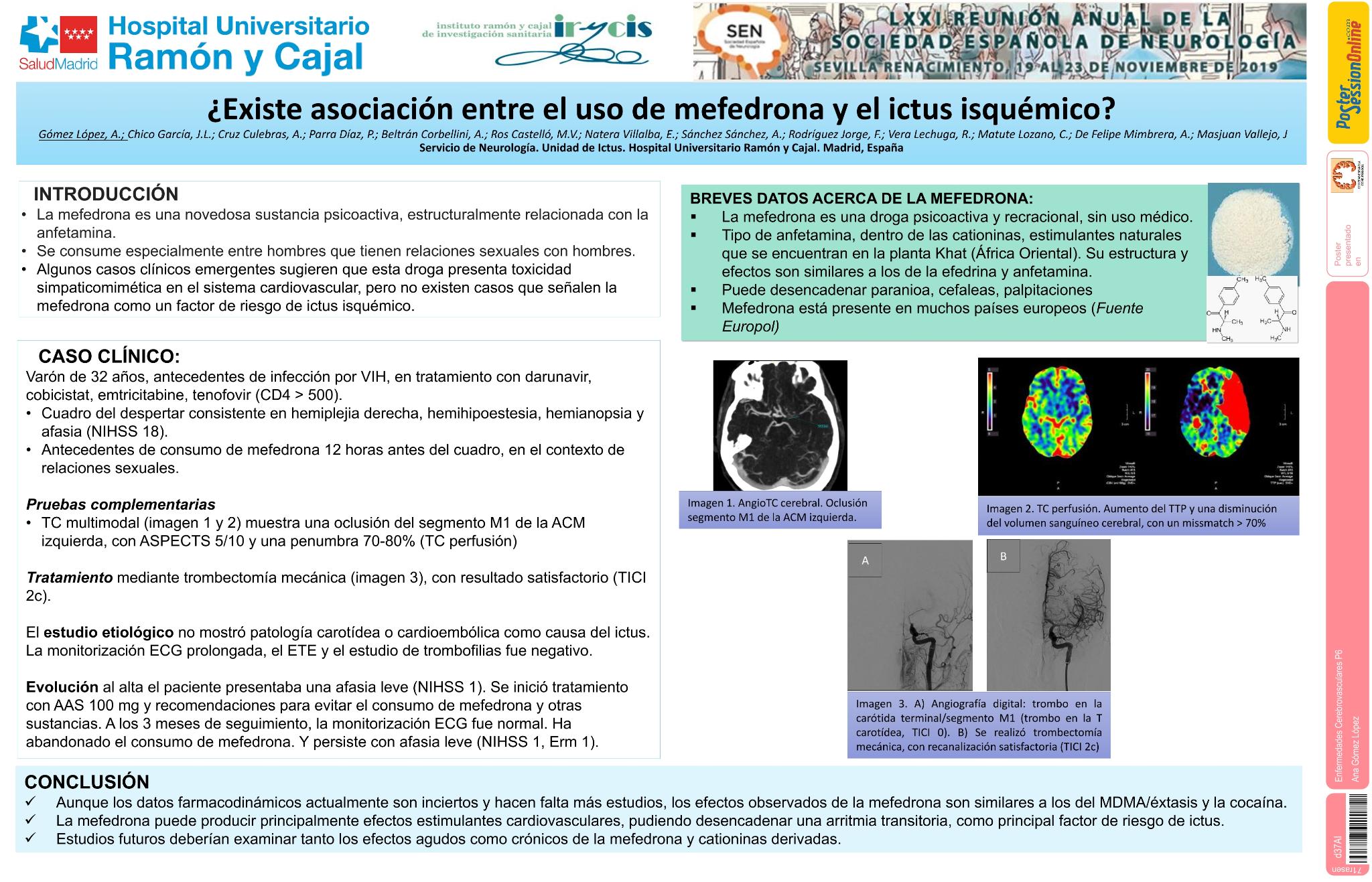 ¿Existe asociación entre el uso de mefedrona y el ictus isquémico?