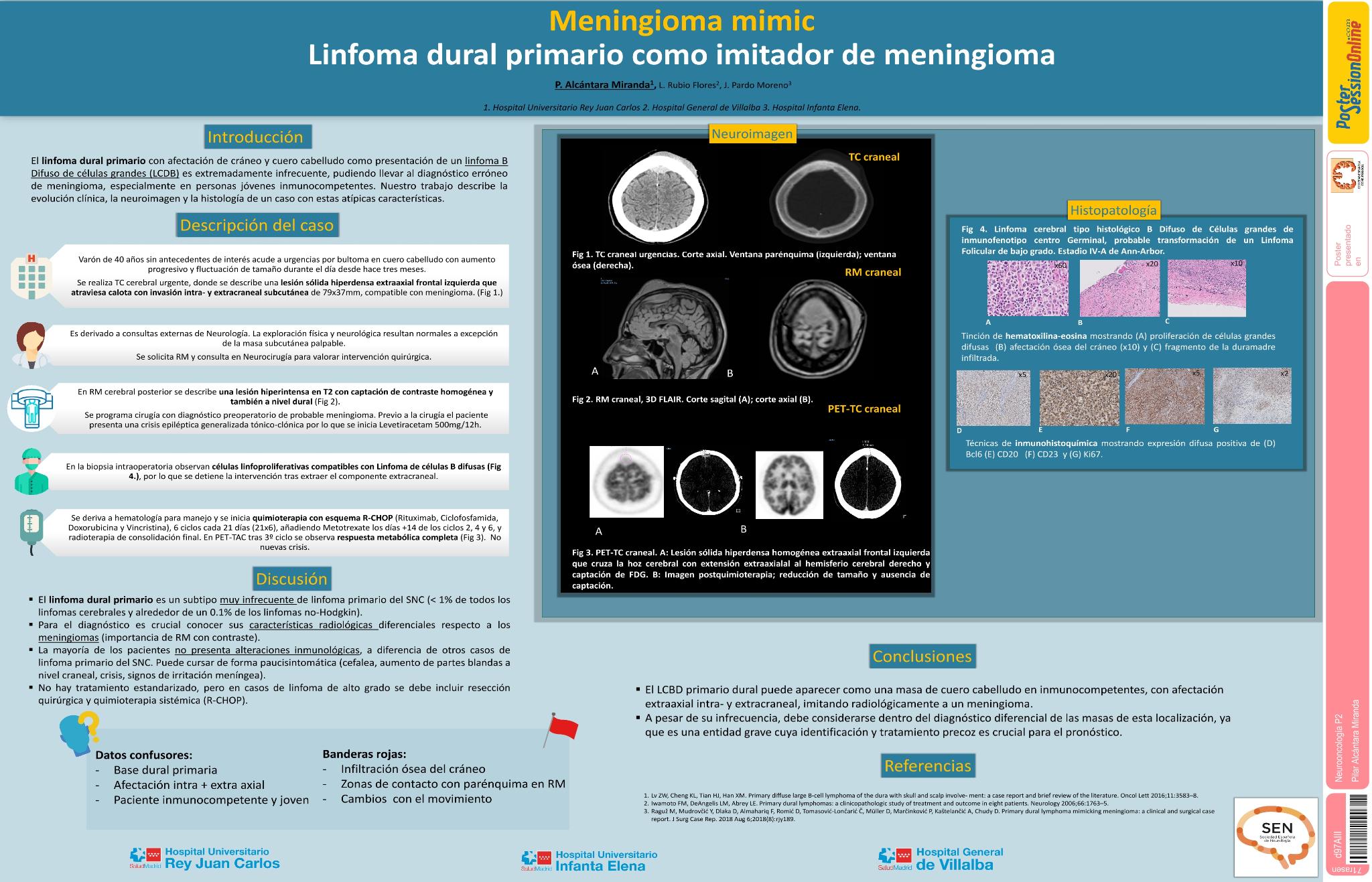 Meningioma mimic: linfoma dural primario como imitador de meningioma