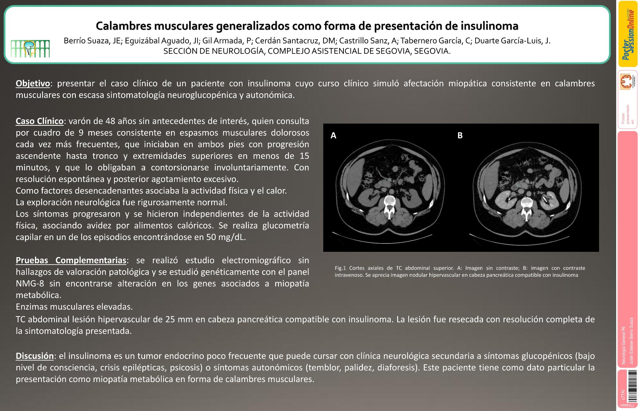 Calambres musculares generalizados como forma atípica de presentación de insulinoma