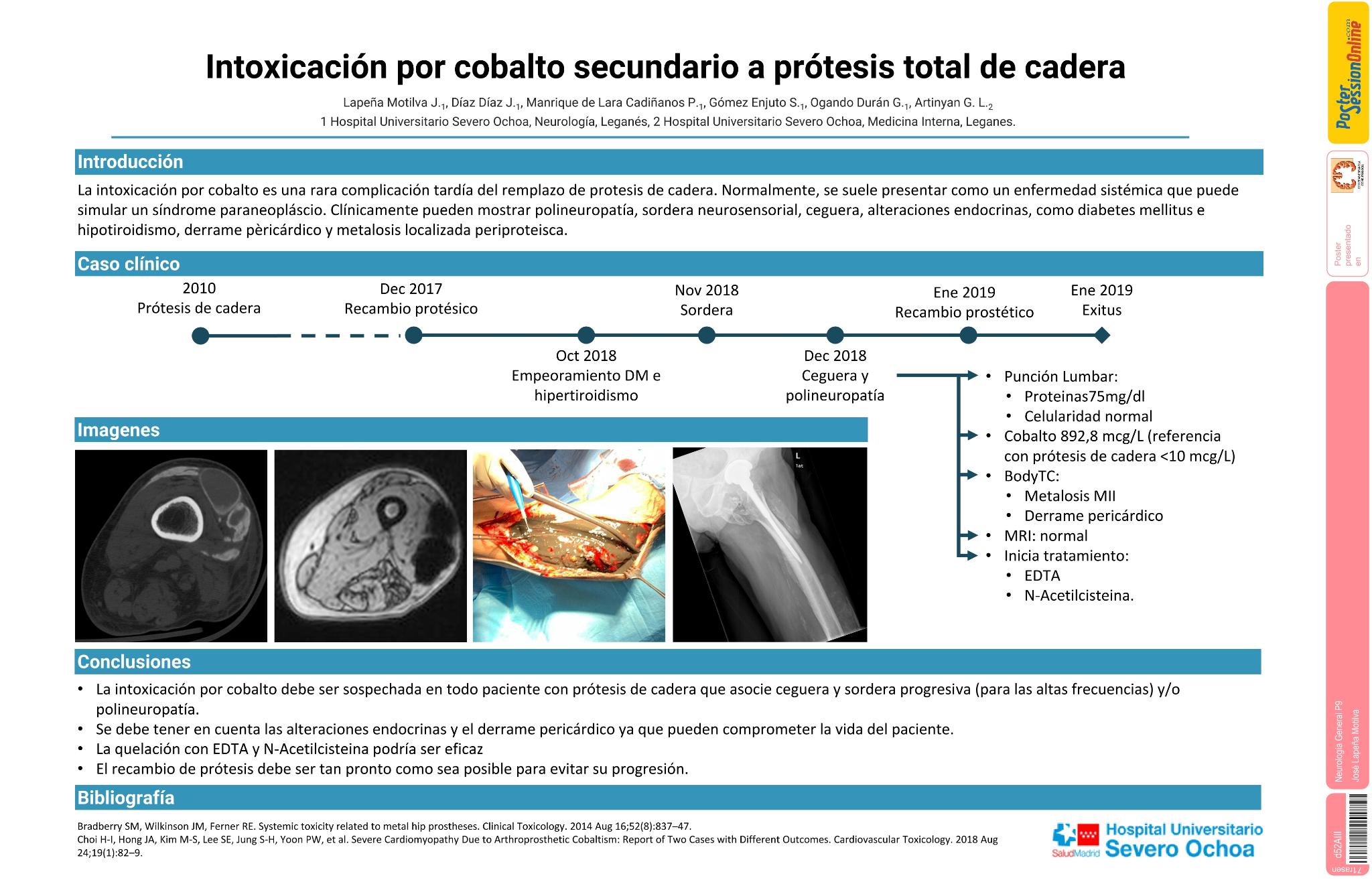 Intoxicación por cobalto secundario a prótesis total de cadera