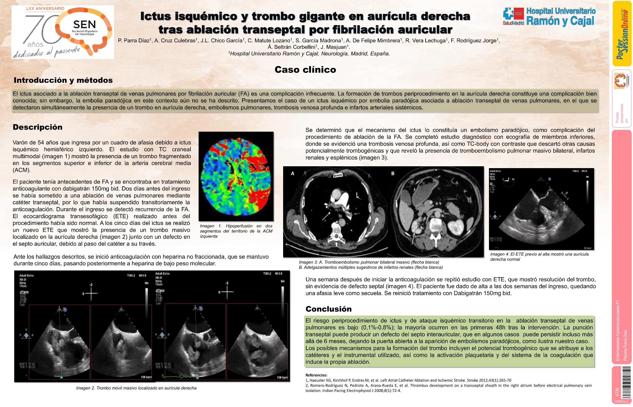 Ictus isquémico y trombo gigante en aurícula derecha tras ablación transeptal por fibrilación auricular