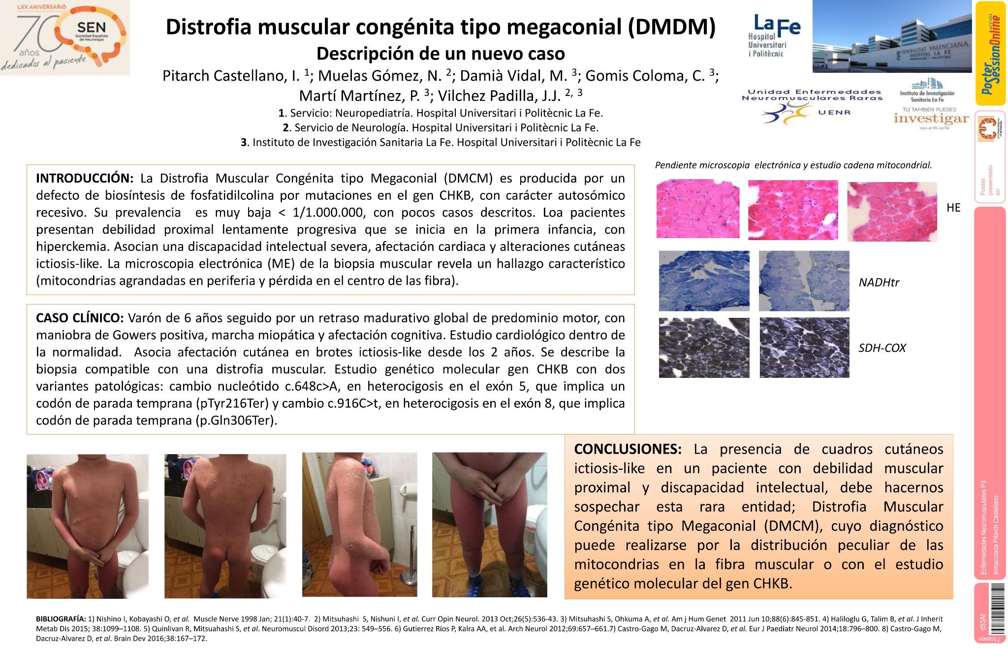 Distrofia muscular congénita tipo megaconial. Descripción de un nuevo caso