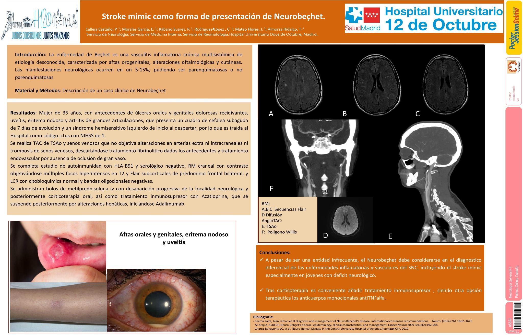 Stroke mimic como forma de presentación de Neurobeçhet