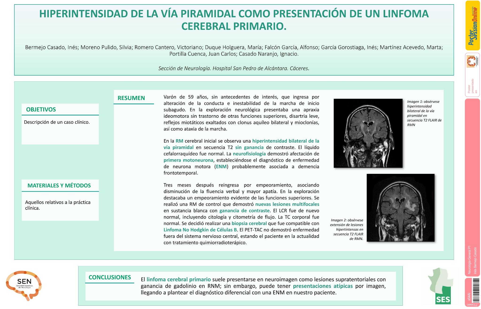 Hiperintensidad de la vía piramidal como presentación de un linfoma cerebral primario