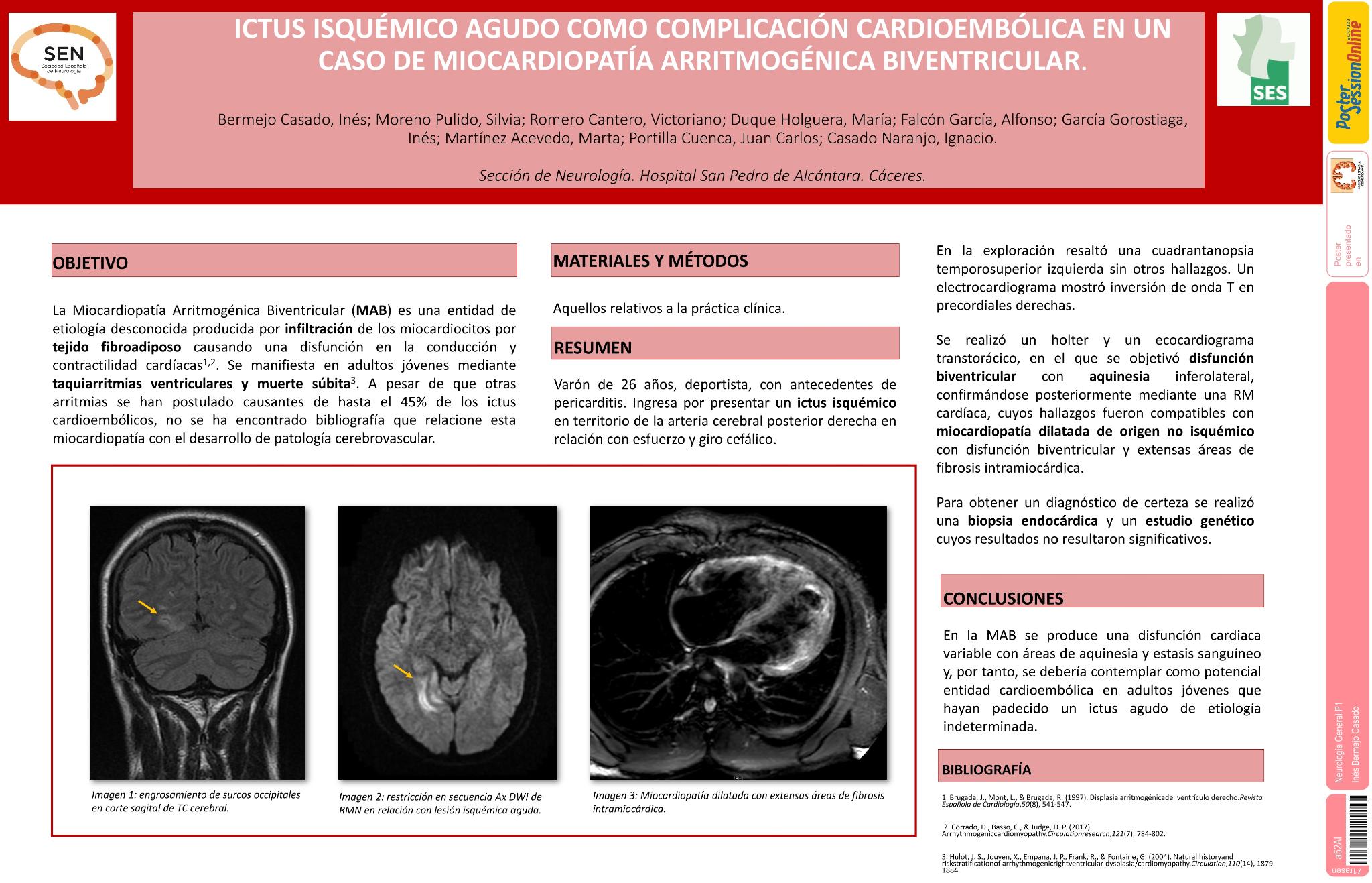 Ictus isquémico agudo como complicación cardioembólica en un caso de miocardiopatía arritmogénica biventricular