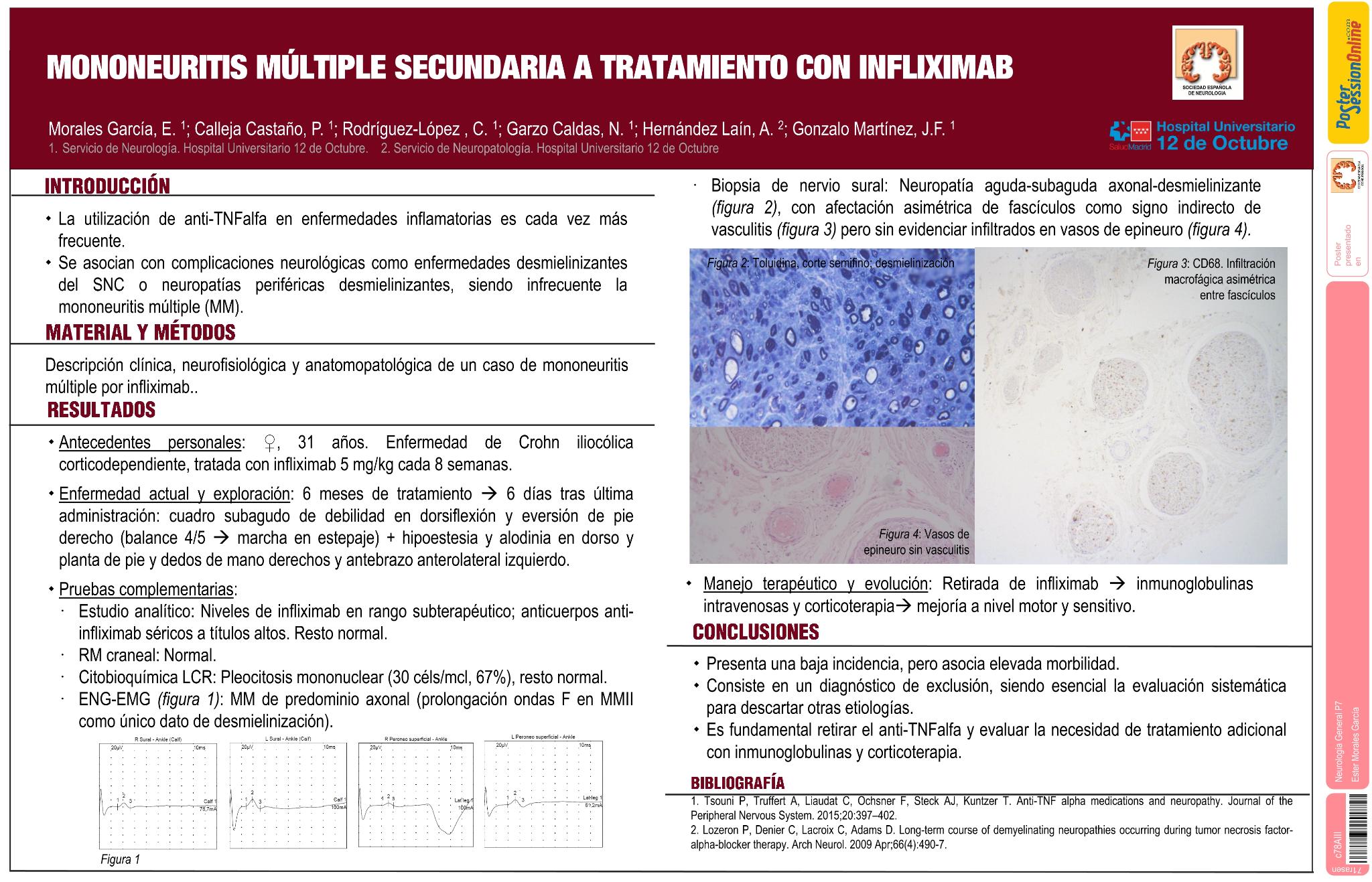 Mononeuritis múltiple secundaria a tratamiento con infliximab