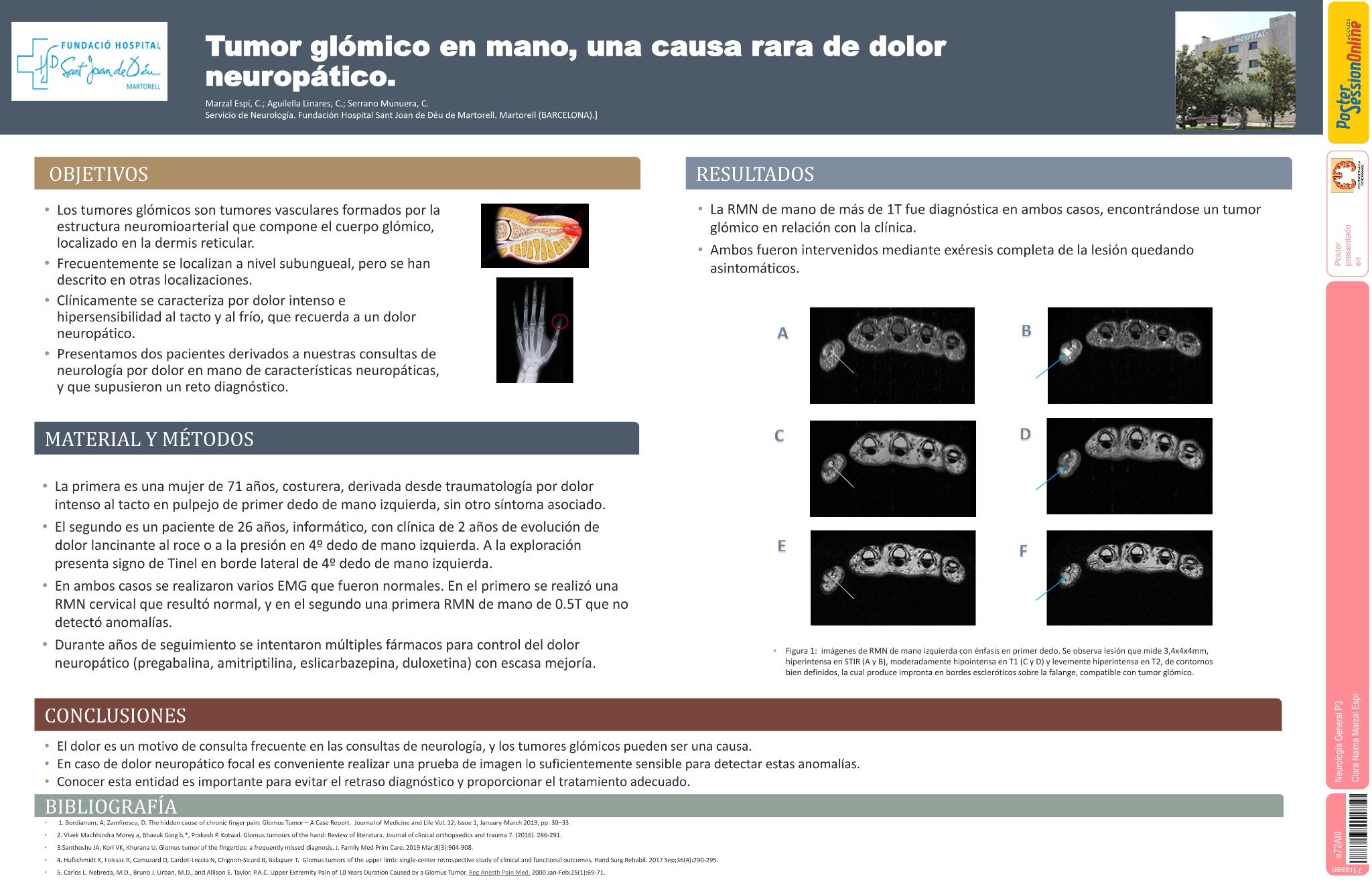 Tumor glómico en mano, una causa rara de dolor neuropático
