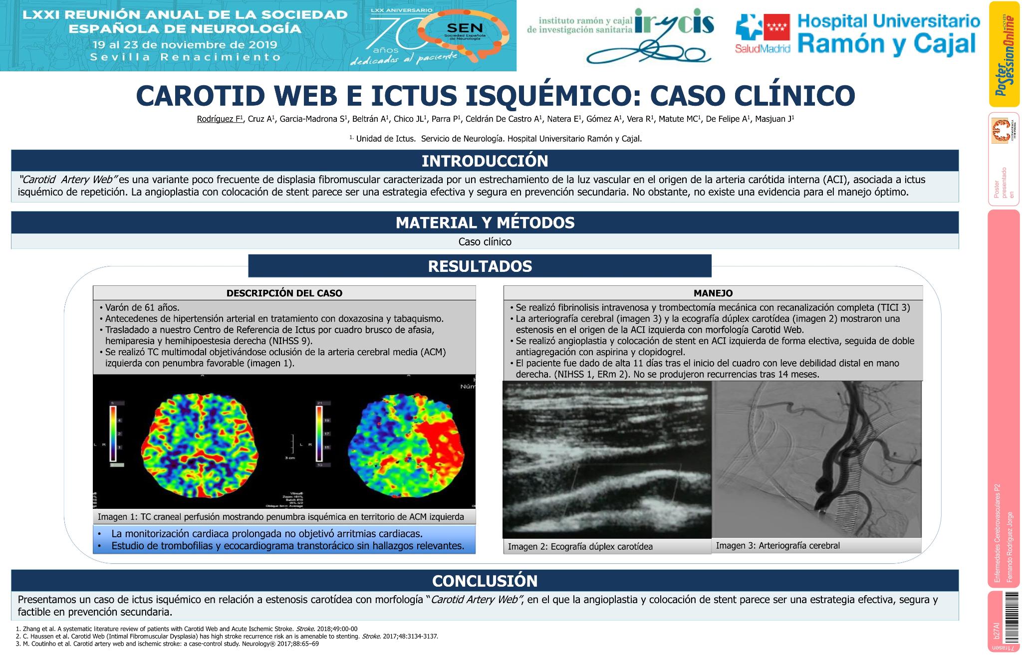 Carotid Web e ictus isquémico: caso clínico