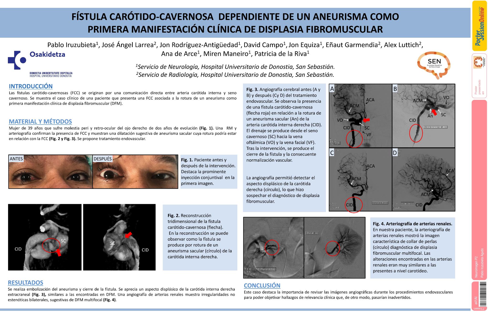 Fístula carótido-cavernosa como primera manifestación clínica de displasia fibromuscular