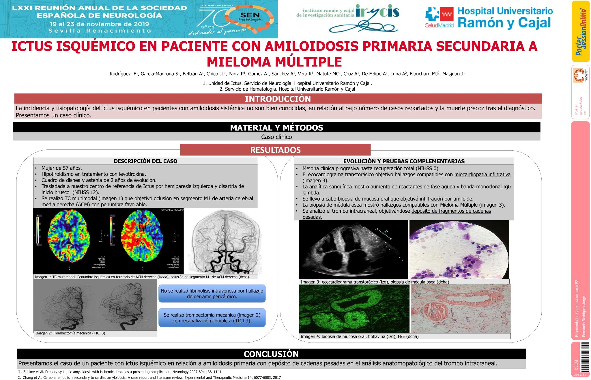 Ictus isquémico en paciente con Amiloidosis Primaria secundaria a Mieloma Múltiple