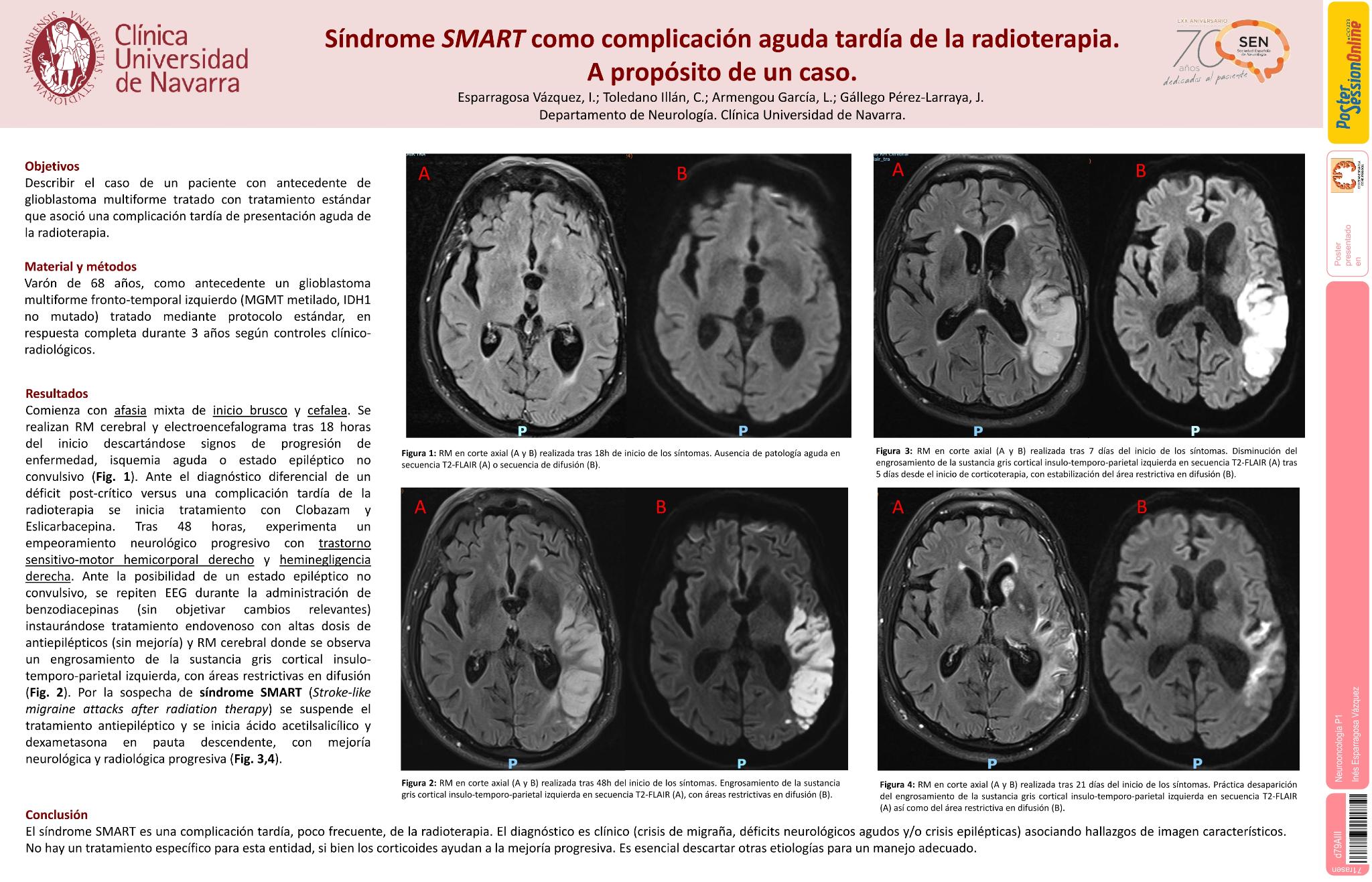 Síndrome Stroke-like como complicación aguda tardía de la radioterapia. A propósito de un caso
