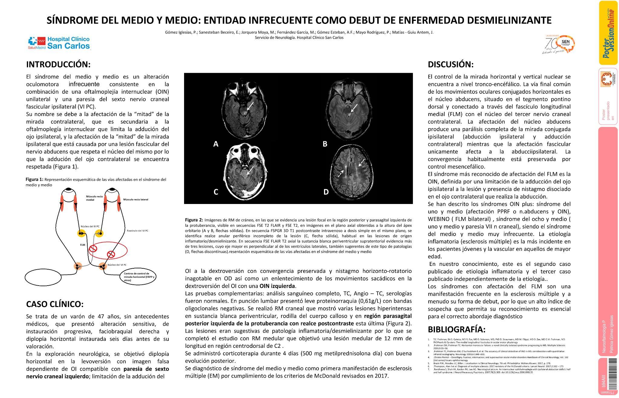 Síndrome del medio y medio: entidad infrecuente como debut de enfermedad desmielinizante