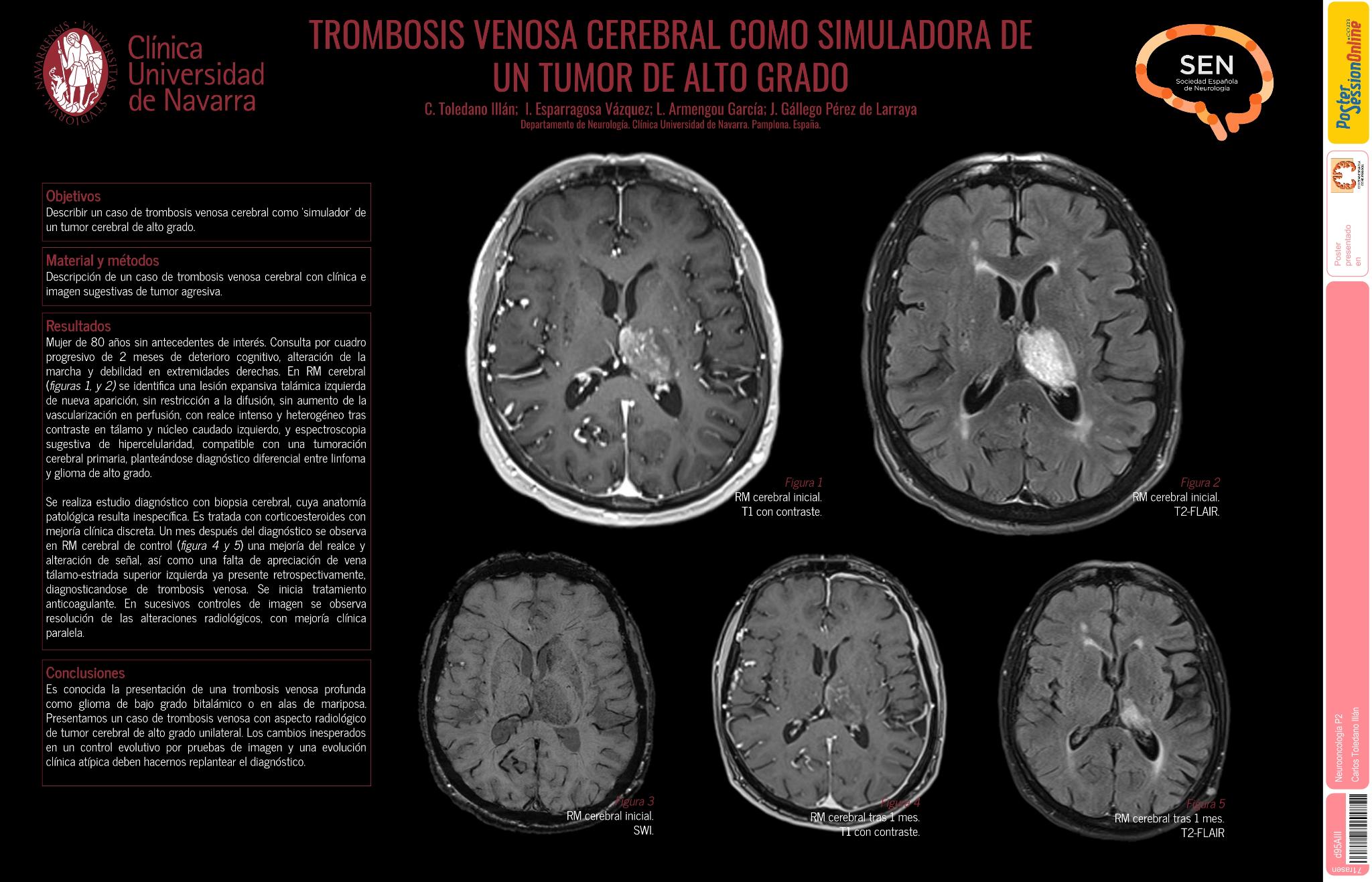 Trombosis venosa cerebral como simuladora de un tumor de alto grado