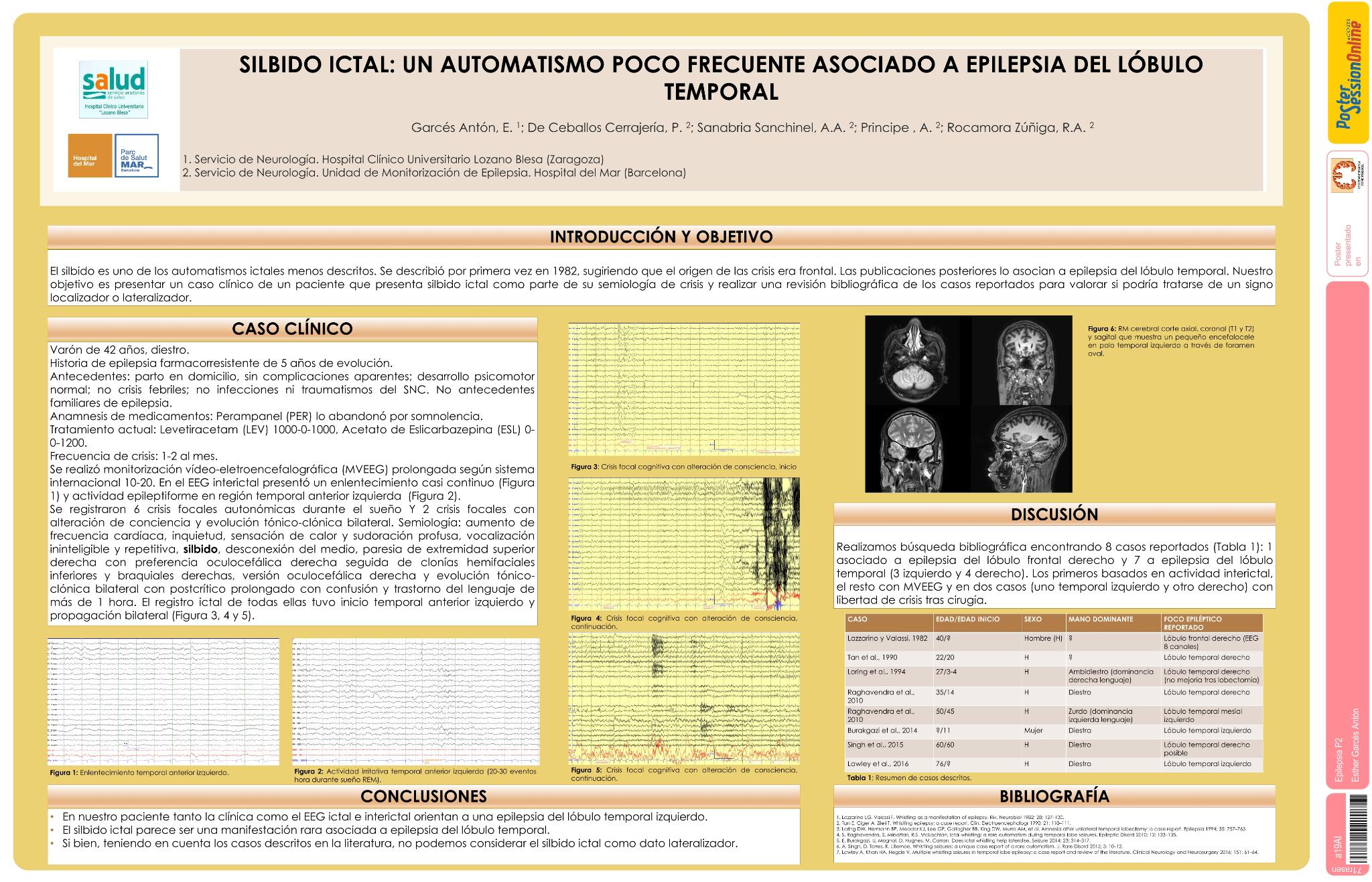 Silbido ictal: un automatismo poco frecuente asociado a epilepsia del lóbulo temporal